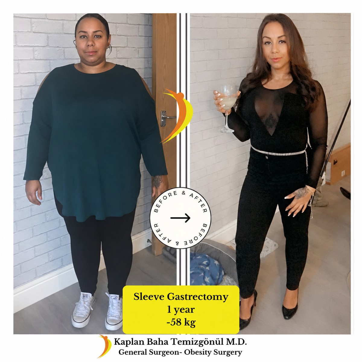 Résultat avant/après sleeve gastrectomie à Lotus Bariatrics Clinic, perte de 58 kg