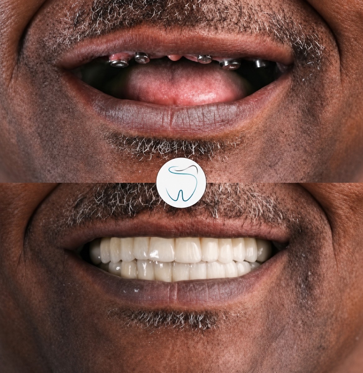 Before and after All-on-4 dental implants result at Megadentist Oral & Dental Aesthetıc Dentistry