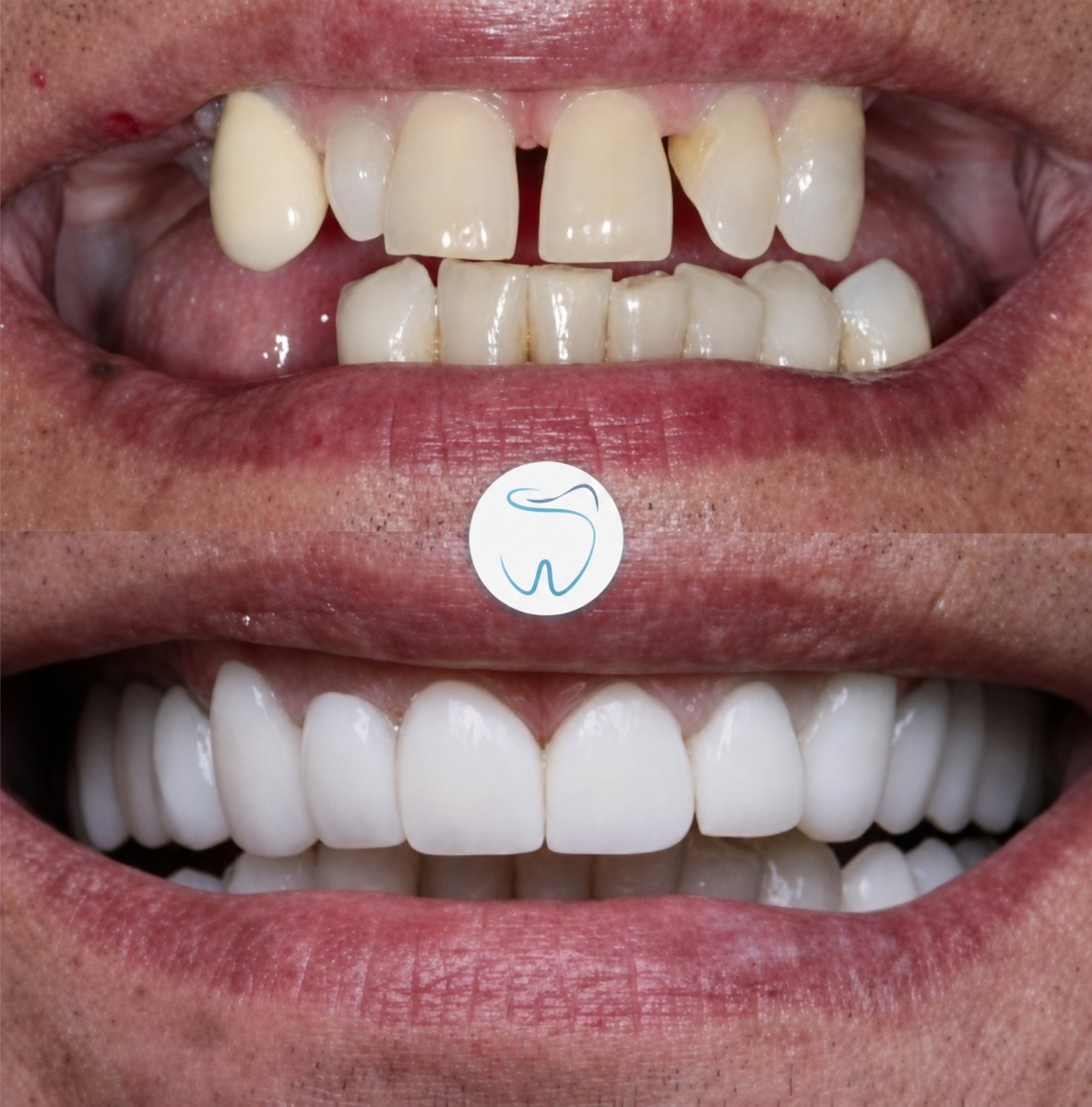 نتائج قبل وبعد عدسات الأسنان الخزفية في عيادة Megadentist Oral & Dental Aesthetic