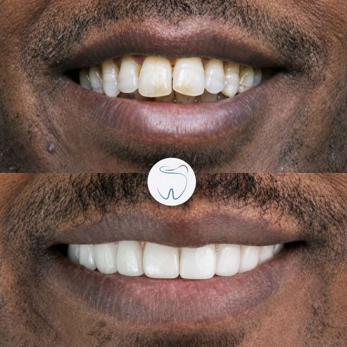 Before and after dental bonding results at Megadentist Oral & Dental Aesthetıc Dentistry