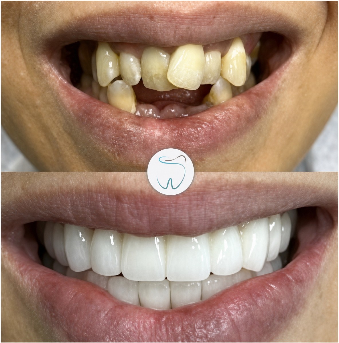 Before and after zirconia crown results at Megadentist Oral & Dental Aesthetıc Dentistry clinic
