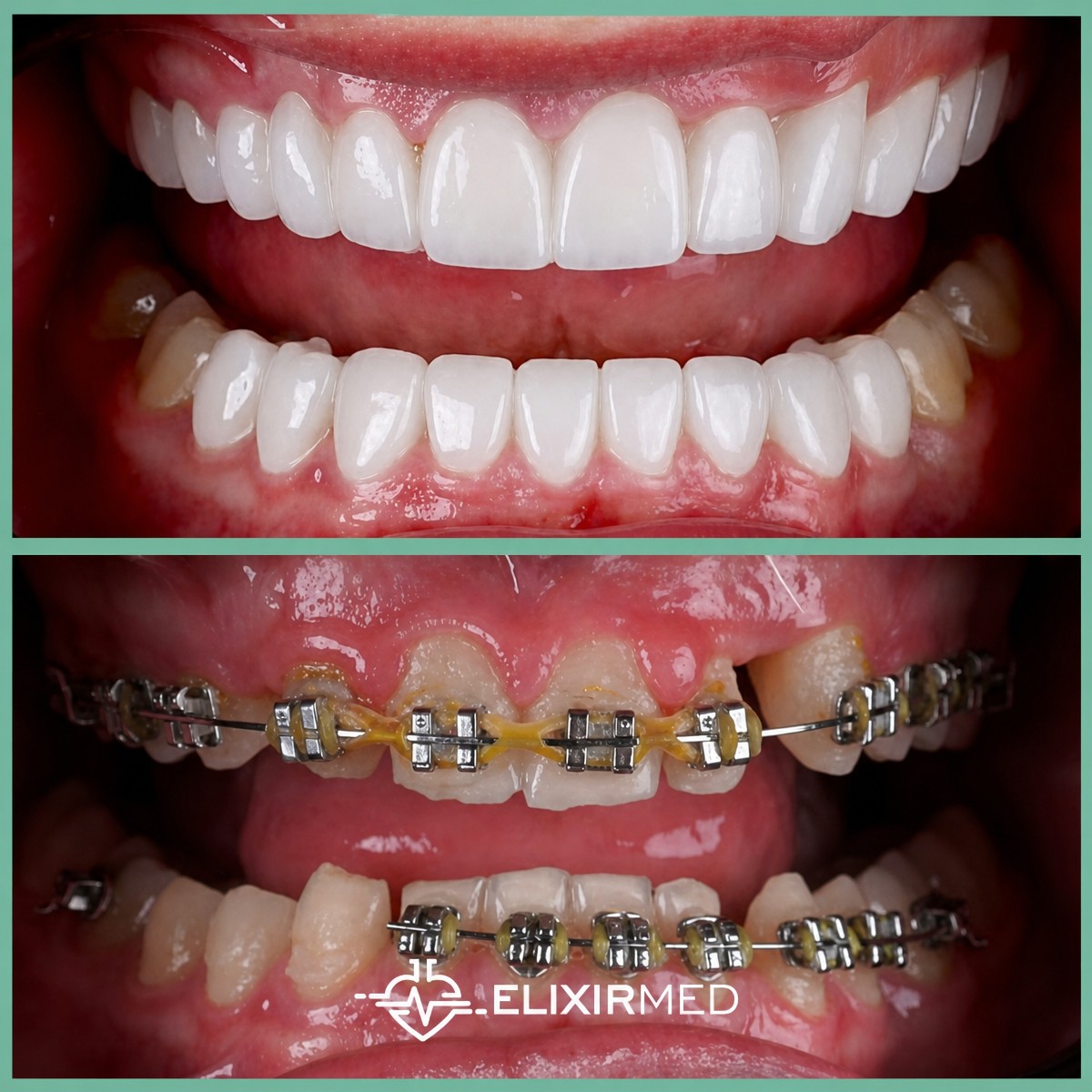 До и после Hollywood Smile в клинике Elixirmed, результат установки виниров