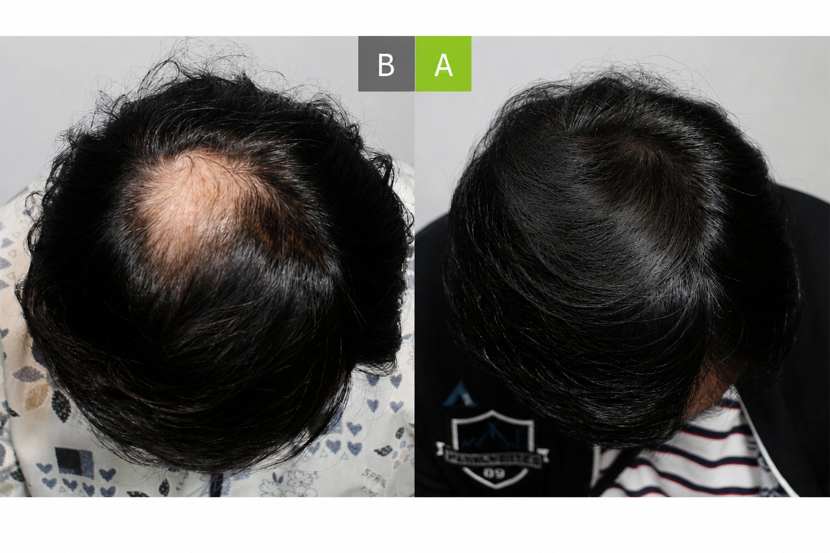 No Shave Hair Transplant before and after results at MOAMAN Hair Transplant Clinic, crown area