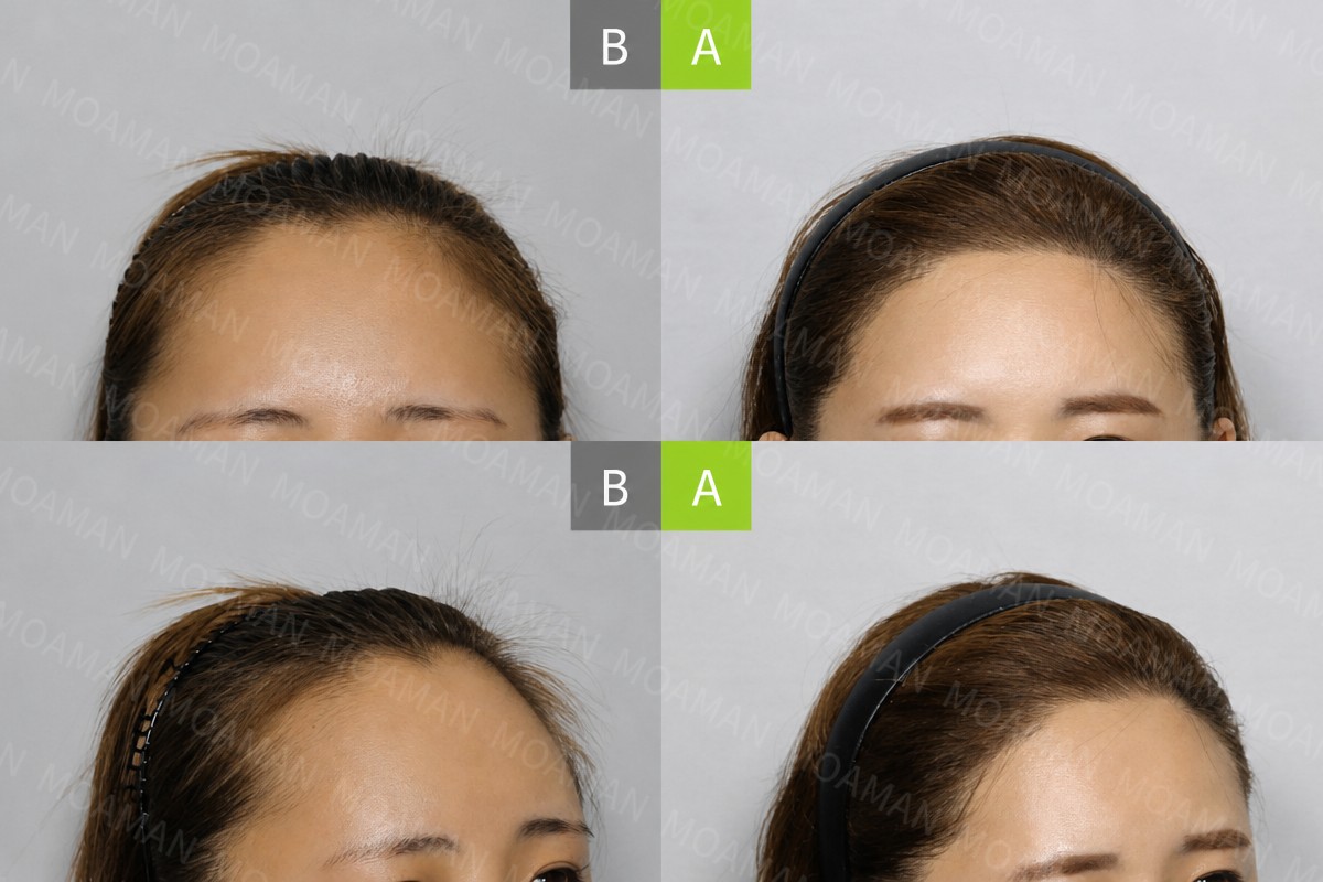 Resultados de trasplante capilar FUE antes y después en MOAMAN, línea de cabello mejorada