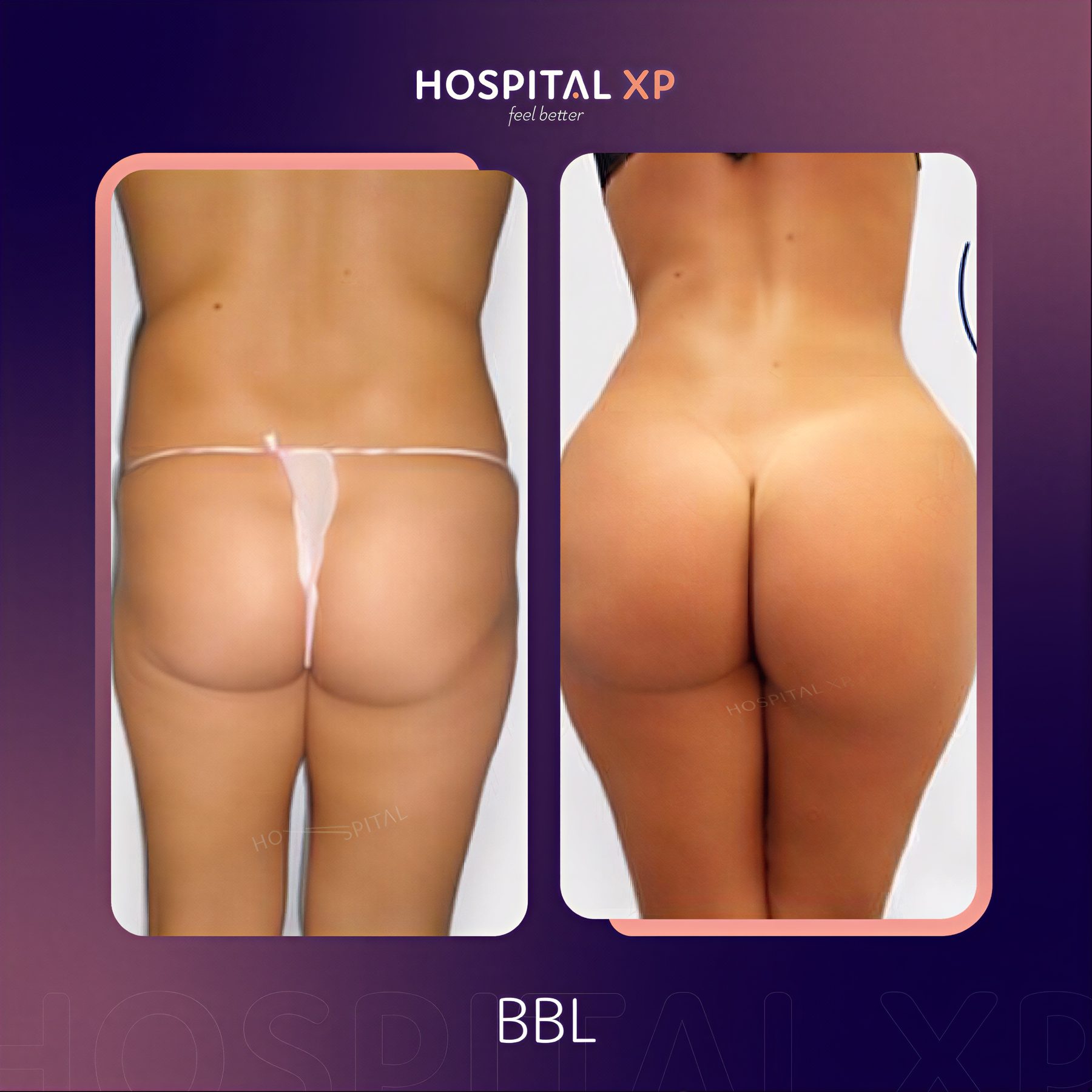 Resultados antes y después de Brazilian Butt Lift en Hospital XP, contorno mejorado