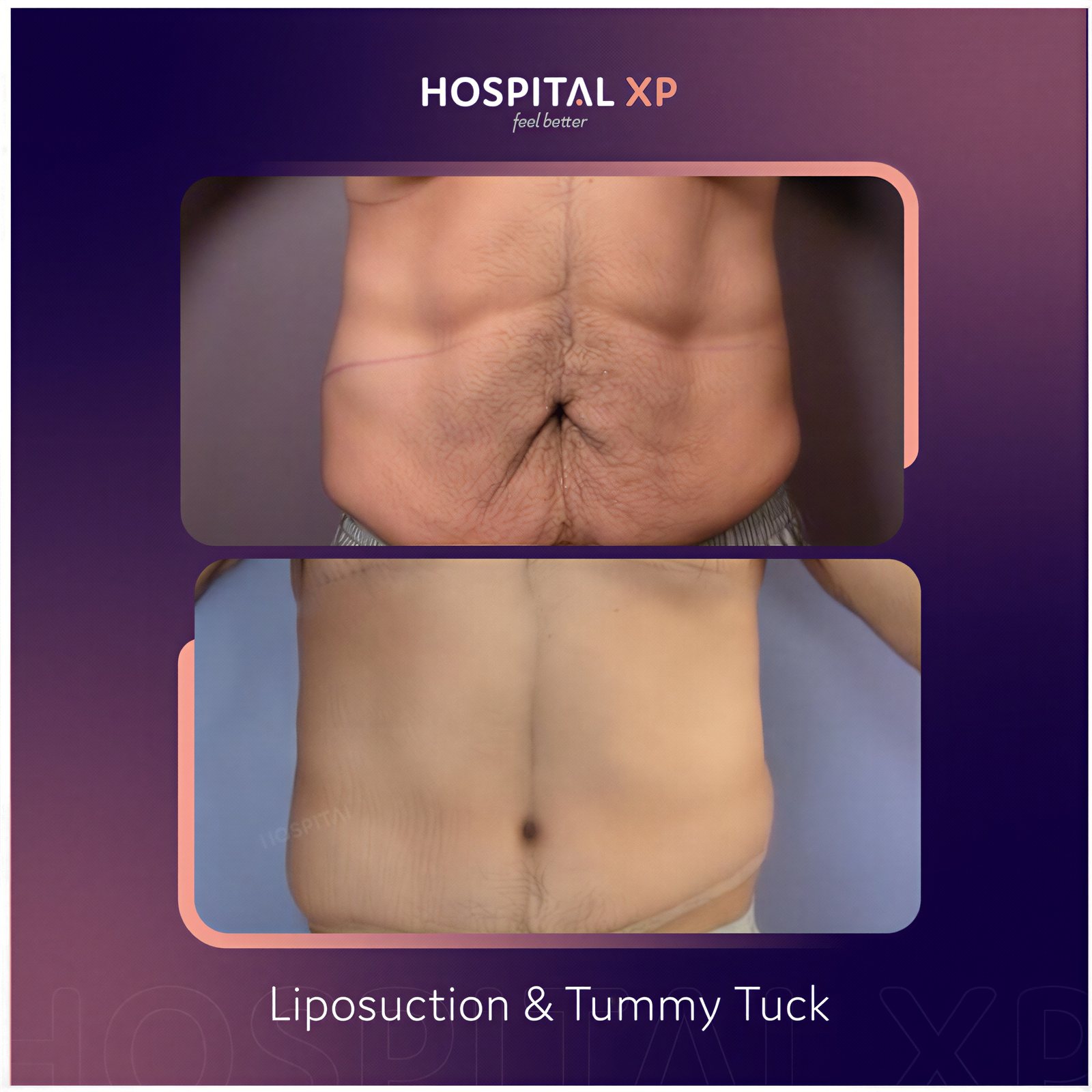 Resultados de abdominoplastia y liposucción antes y después en Hospital XP, abdomen mejorado