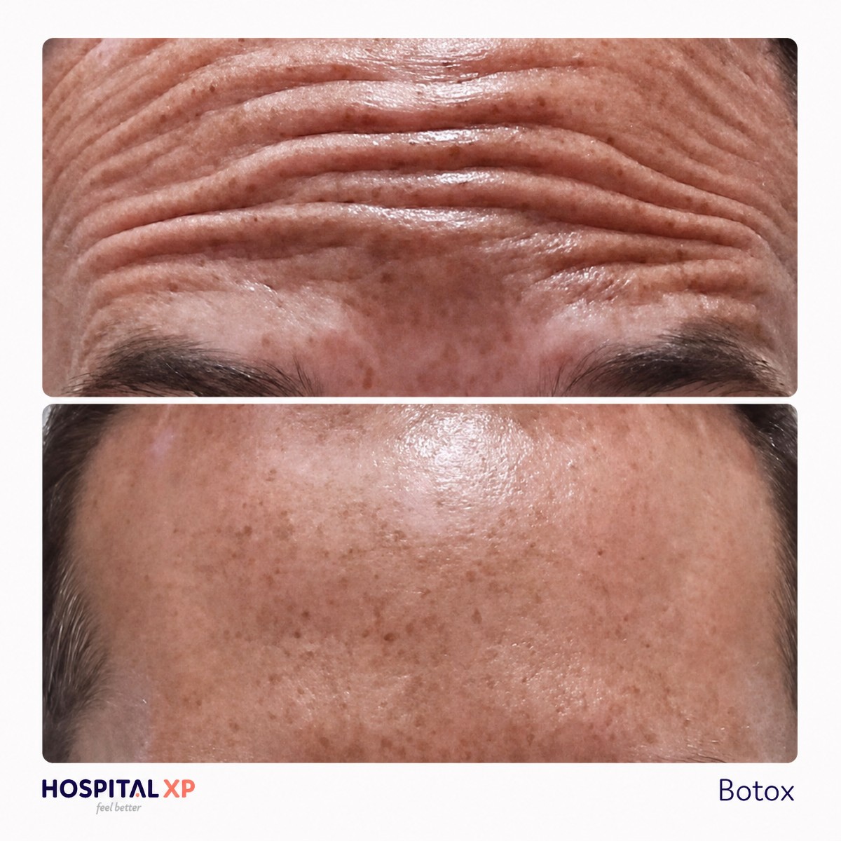 Forehead Botox before and after results at Hospital XP – reduced wrinkles, smoother skin