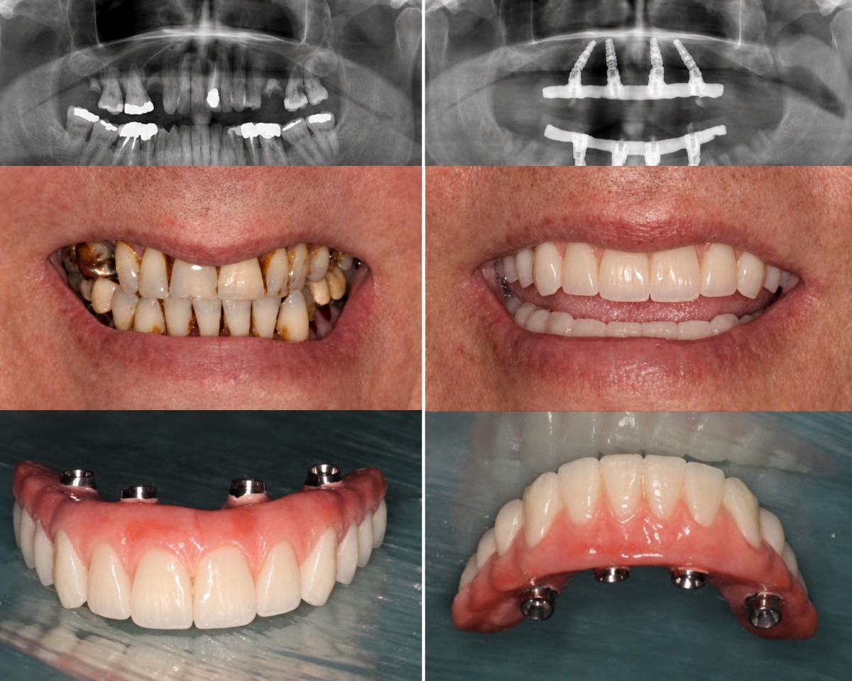 نتائج قبل وبعد زراعة الأسنان All-on-4 في White Dental Turkey، استعادة الابتسامة الكاملة