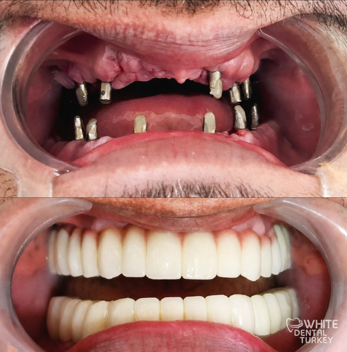 نتيجة قبل وبعد زراعة الأسنان All-on-6 في White Dental Turkey، ترميم كامل للفم