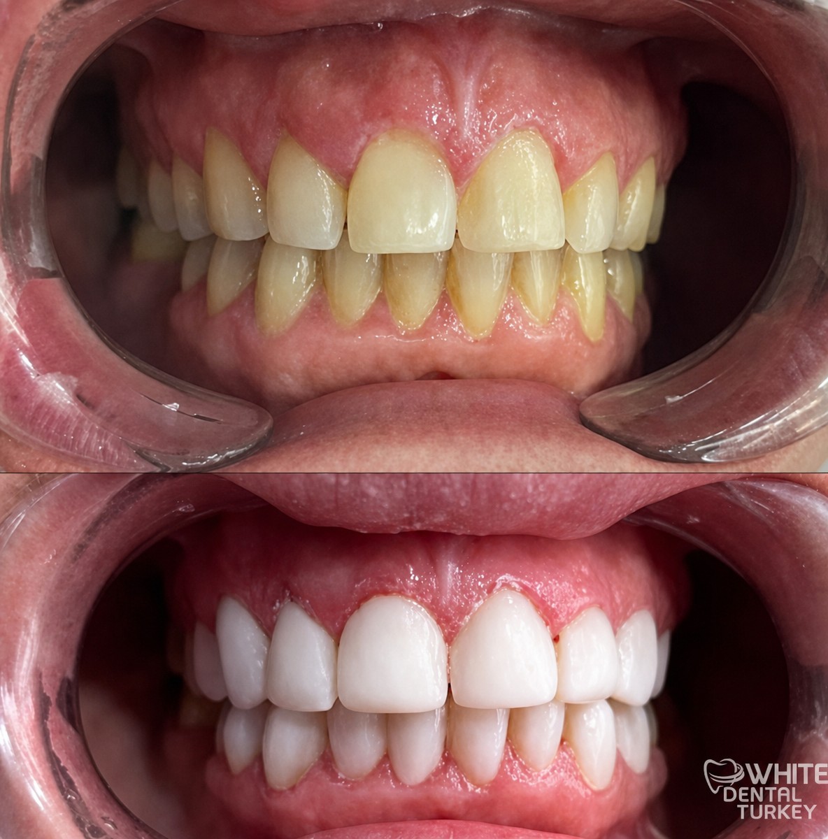 Before and after veneers at White Dental Turkey – smile makeover with whiter, even teeth result