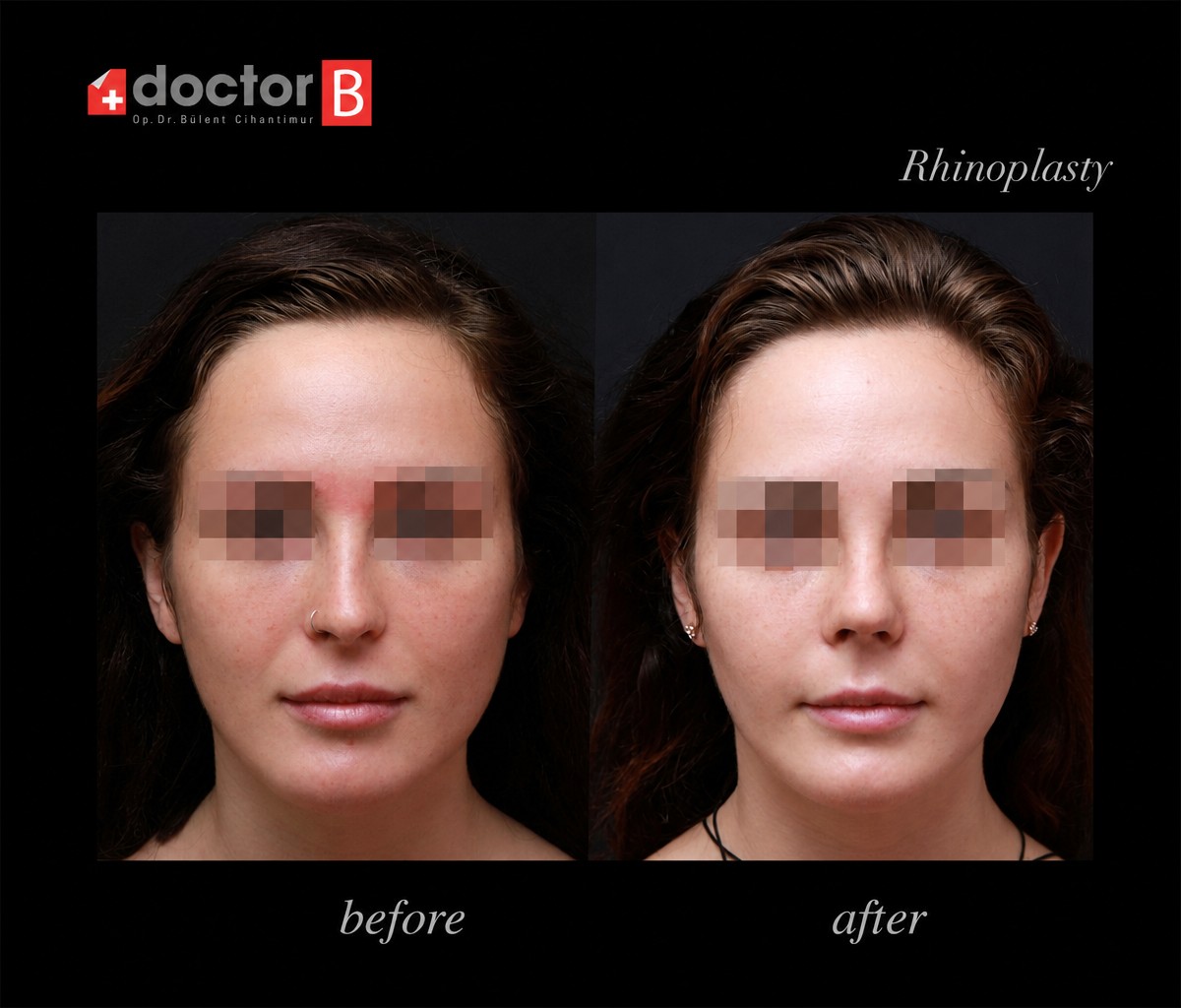 Before and after rhinoplasty results at Doctor B Clinic, nose reshaping with natural outcome
