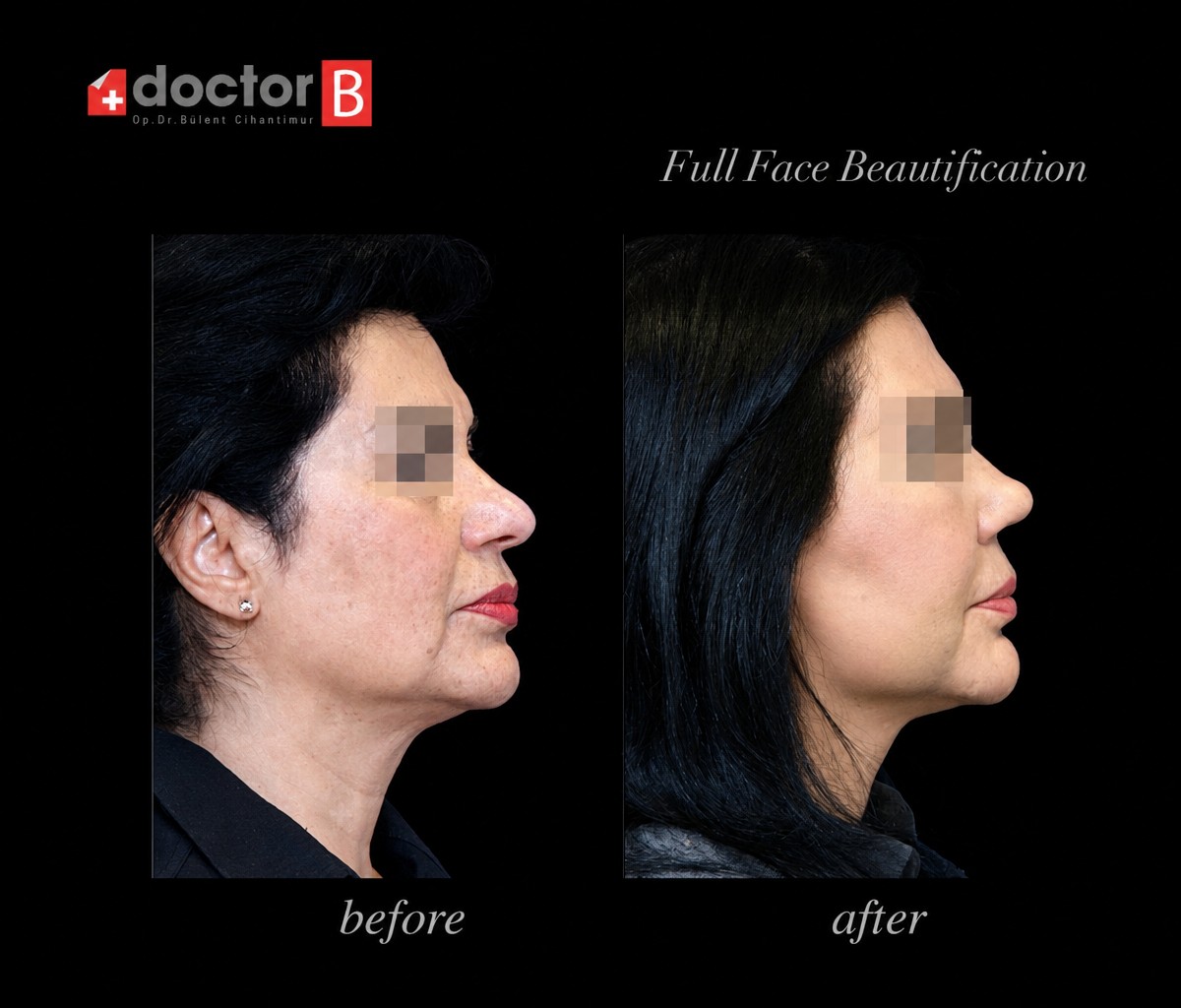 Full face beautification before and after results at Doctor B Clinic, facial contour improvement