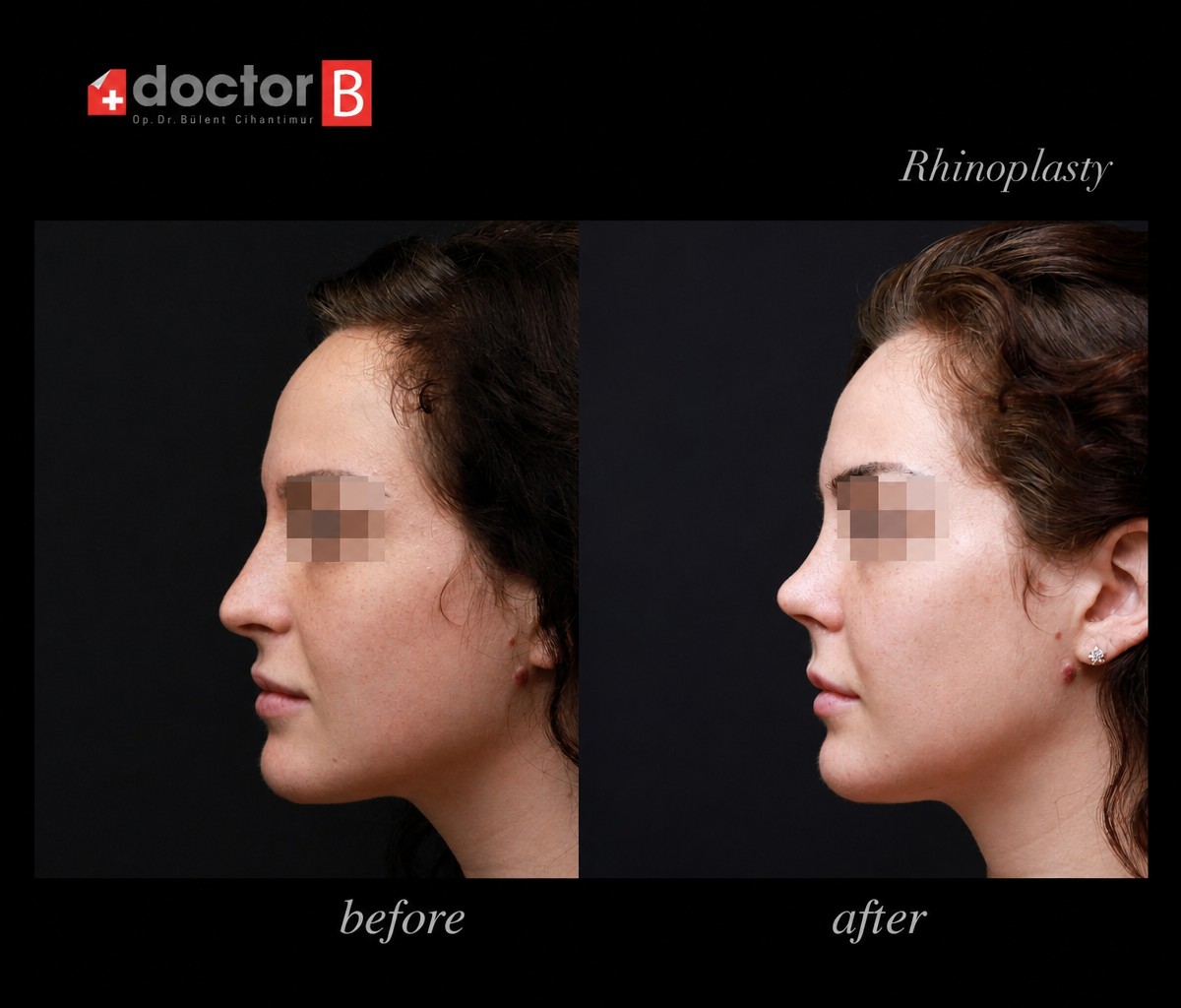 Результаты ринопластики до и после в Doctor B Clinic, естественный профиль носа