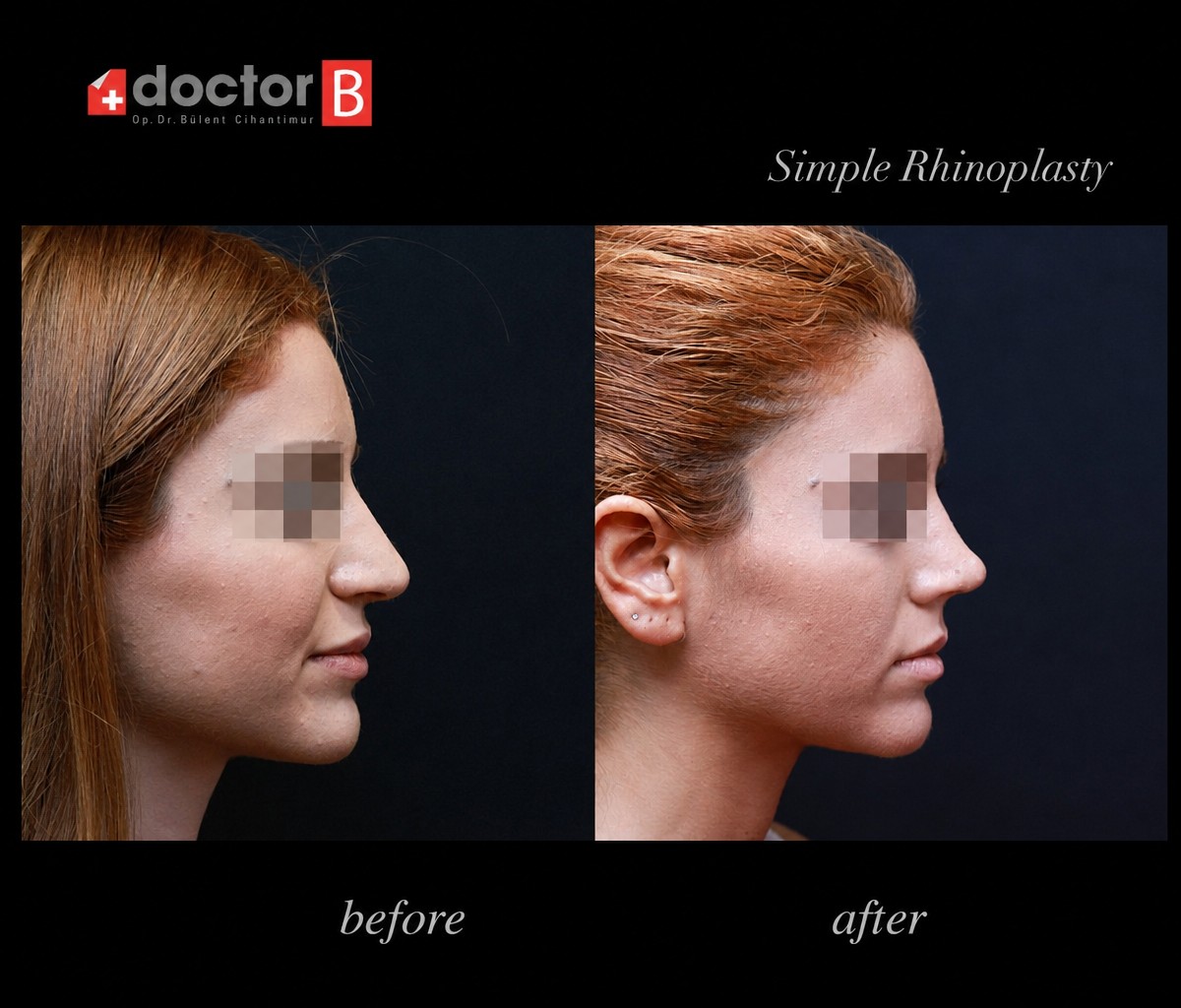Before and after rhinoplasty results at Doctor B Clinic, nose reshaping with natural look