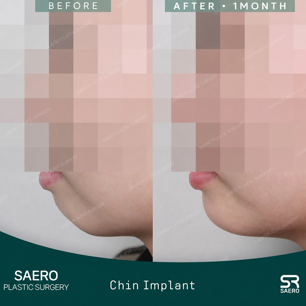 Résultats avant/après implant du menton chez SAERO Plastic Surgery, profil amélioré
