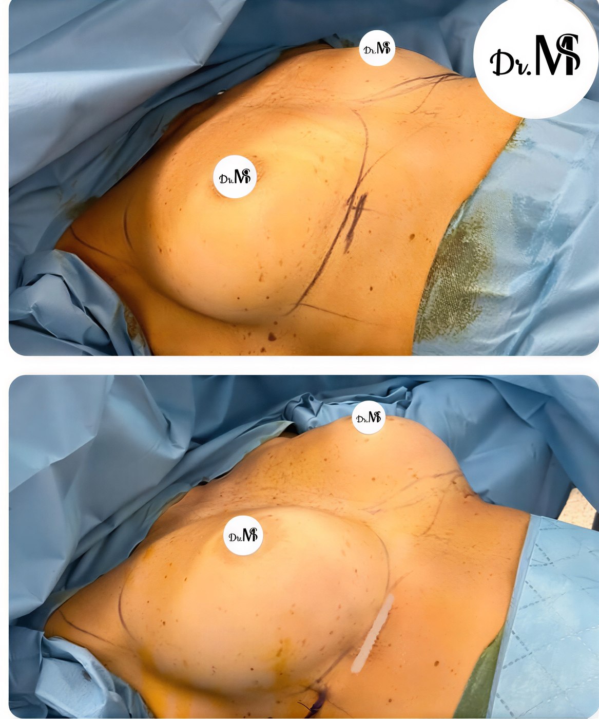 Resultados antes y después de lifting de senos en MERT SECER AESTHETIC AND PLASTIC SURGEON