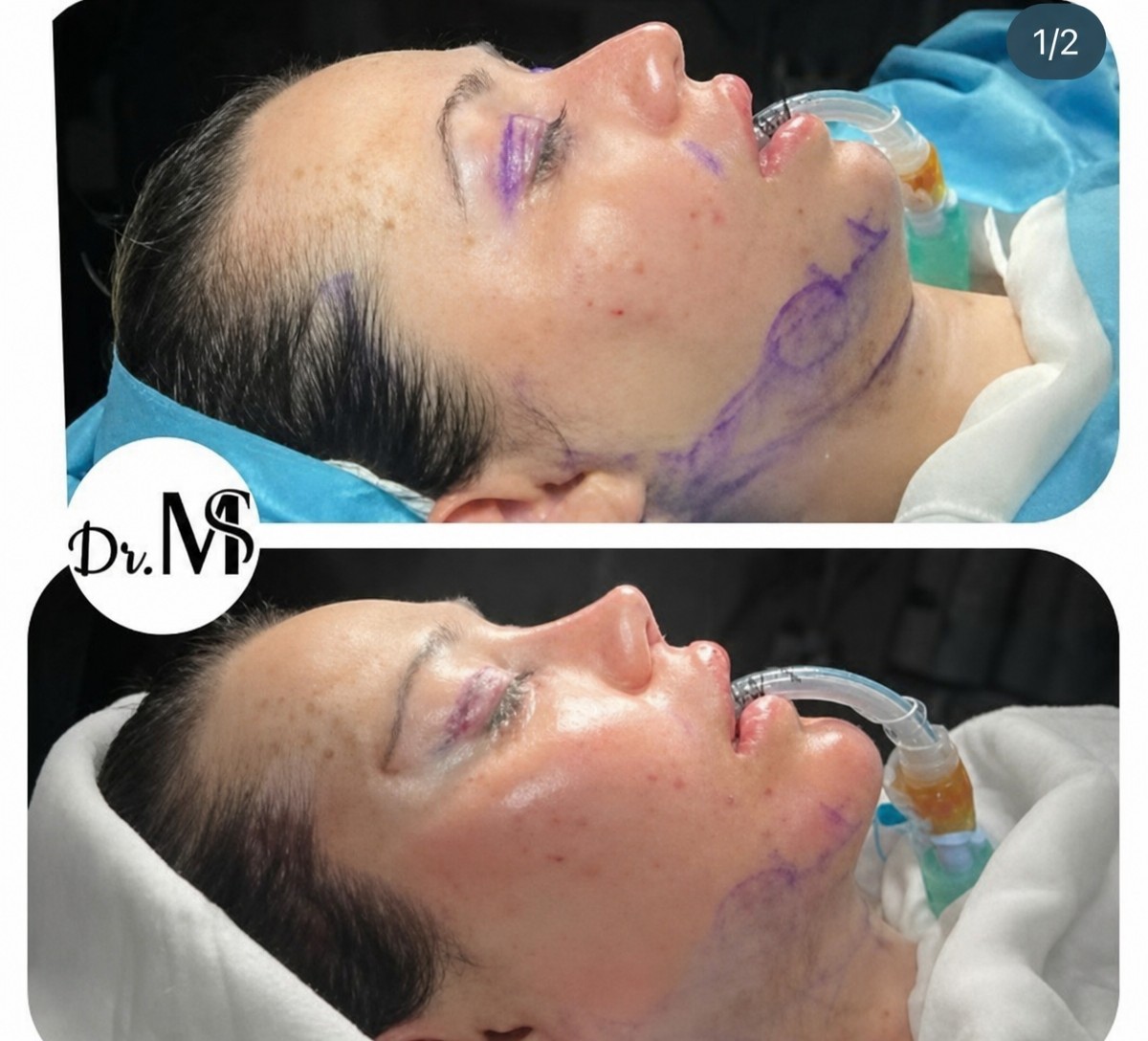 نتائج رأب الجفن قبل وبعد في عيادة MERT SECER AESTHETIC AND PLASTIC SURGEON