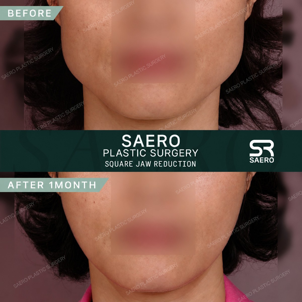 Vorher-nachher Kieferformung bei SAERO Plastic Surgery – sichtbare Kieferreduktion