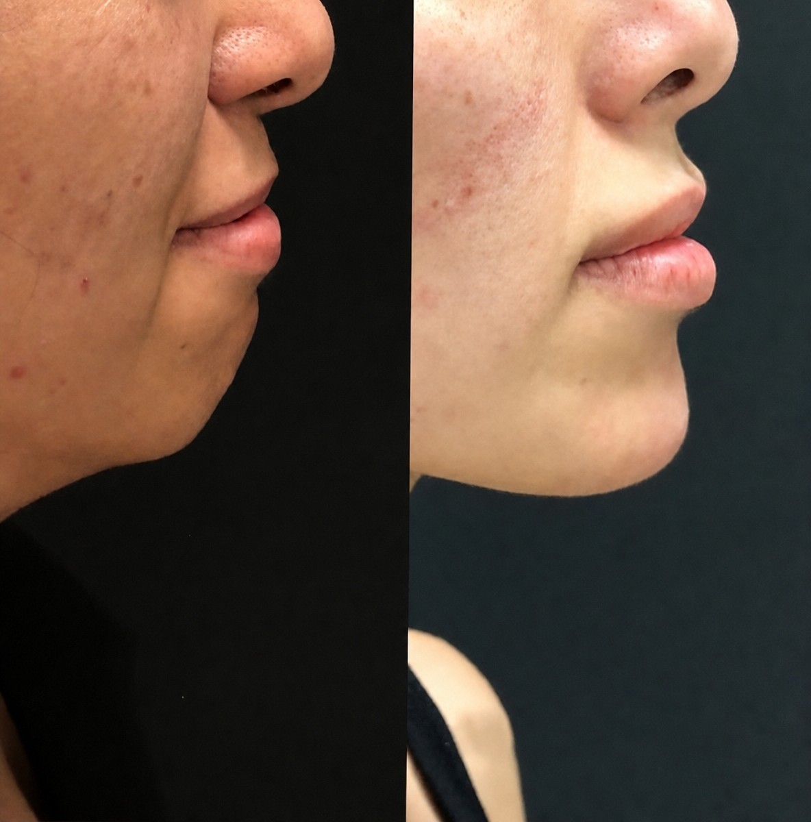 Resultados antes y después de implante de mentón en MERT SECER AESTHETIC AND PLASTIC SURGEON, perfil mejorado