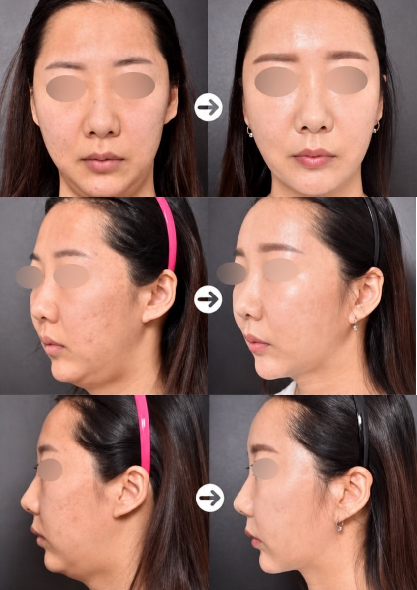 Before and after liposculpture at VG Plastic Surgery, facial contouring and jawline result