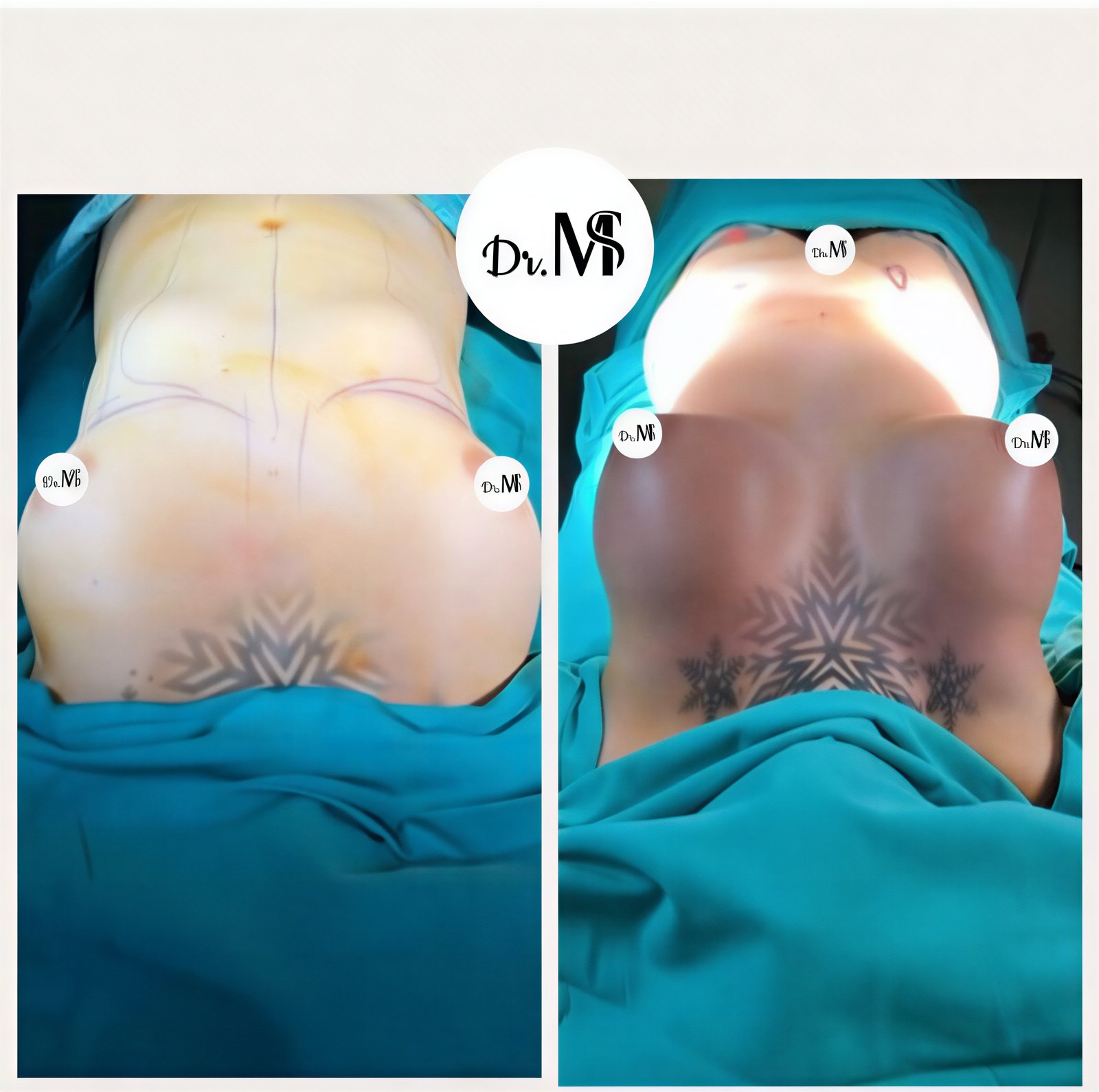 Resultados antes y después de lifting de senos en MERT SECER AESTHETIC AND PLASTIC SURGEON