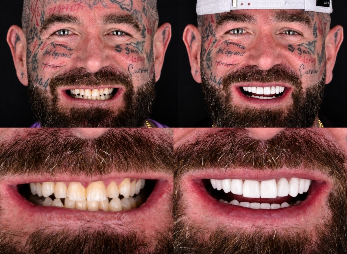 Resultados antes y después de carillas de porcelana en Unique Dental Clinic – transformación de sonrisa