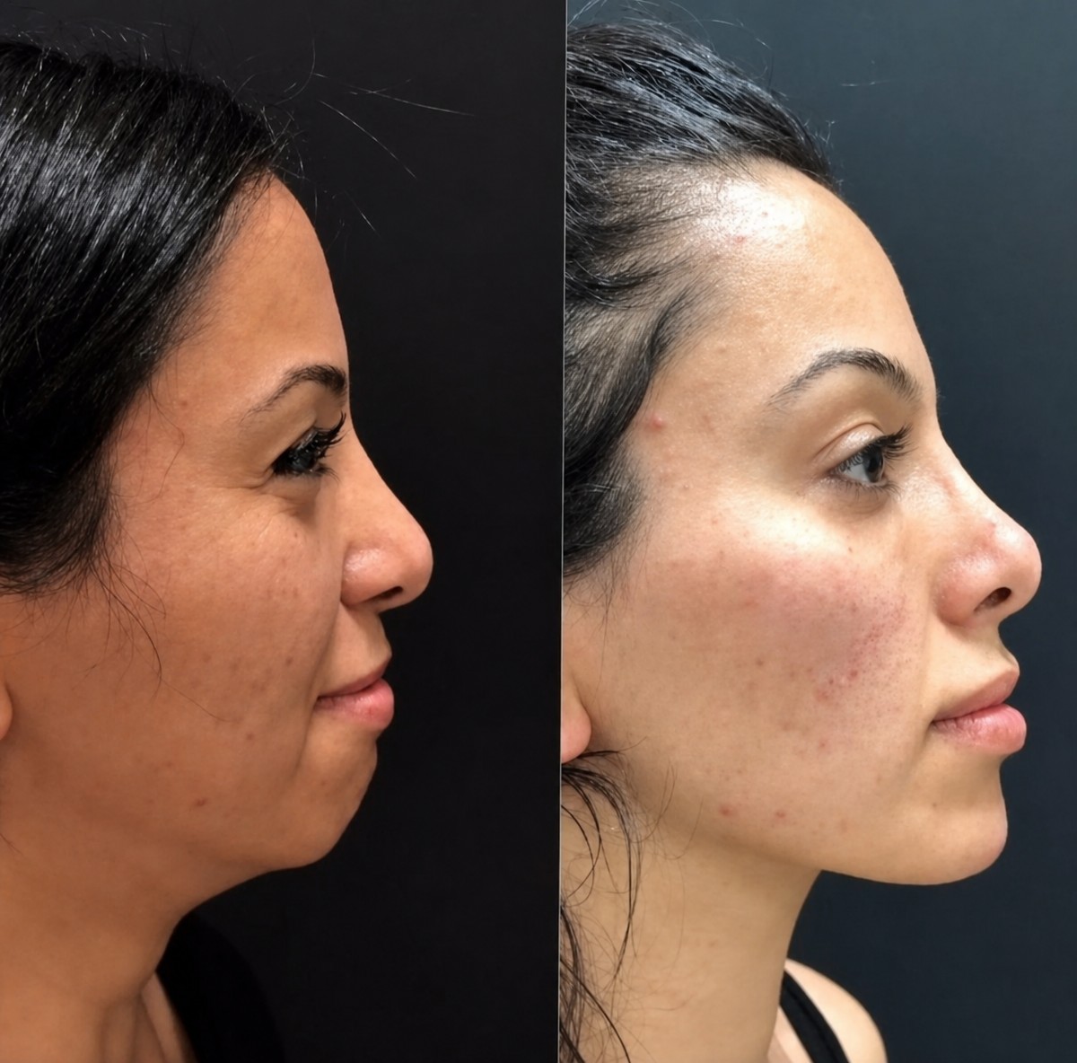 Before and after jaw shaping results at MERT SECER AESTHETIC AND PLASTIC SURGEON clinic