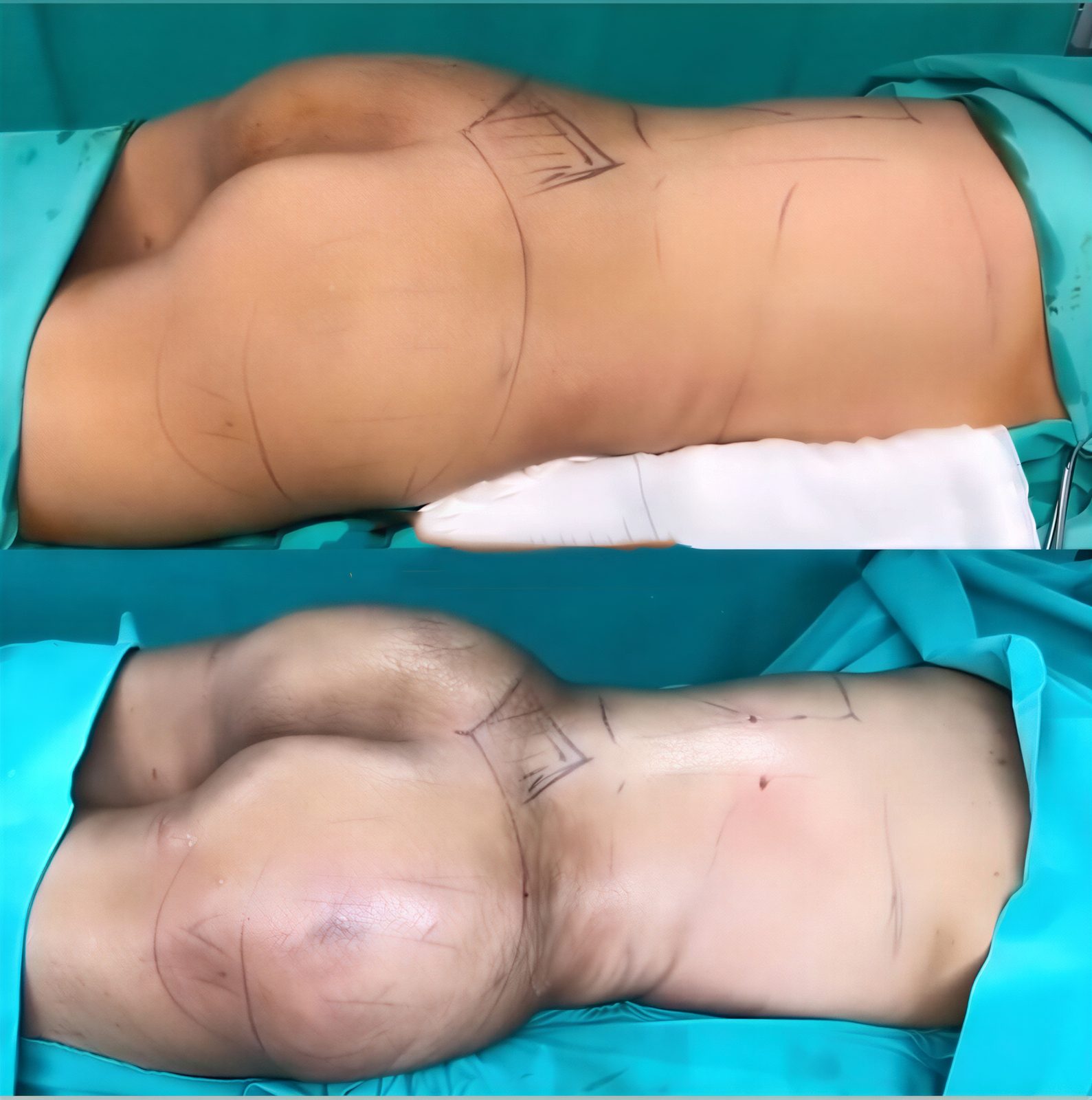 نتائج قبل وبعد شفط الدهون ونحت الجسم في MERT SECER AESTHETIC AND PLASTIC SURGEON