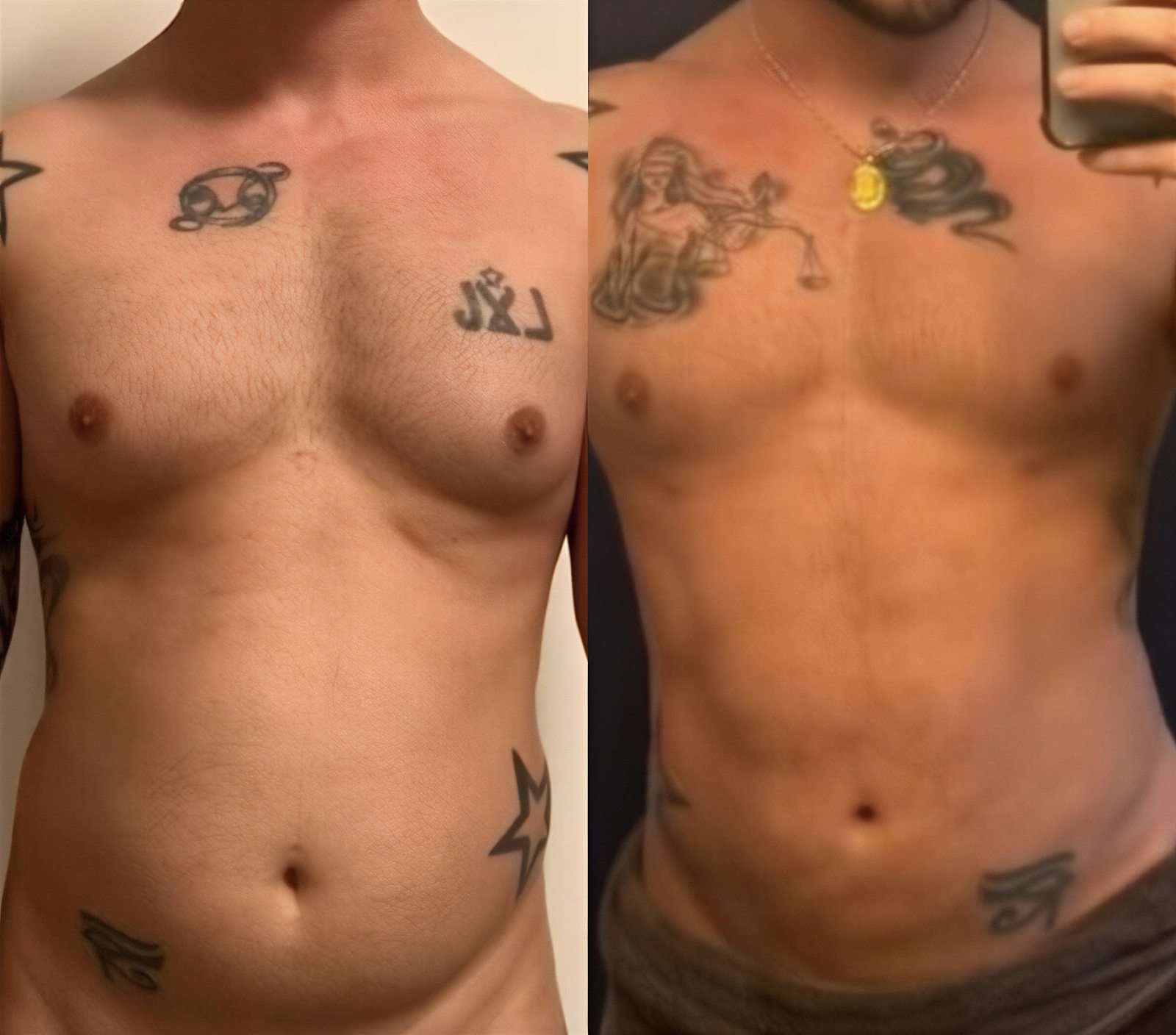 نتائج شفط الدهون قبل وبعد في MERT SECER AESTHETIC AND PLASTIC SURGEON، بطن مسطح