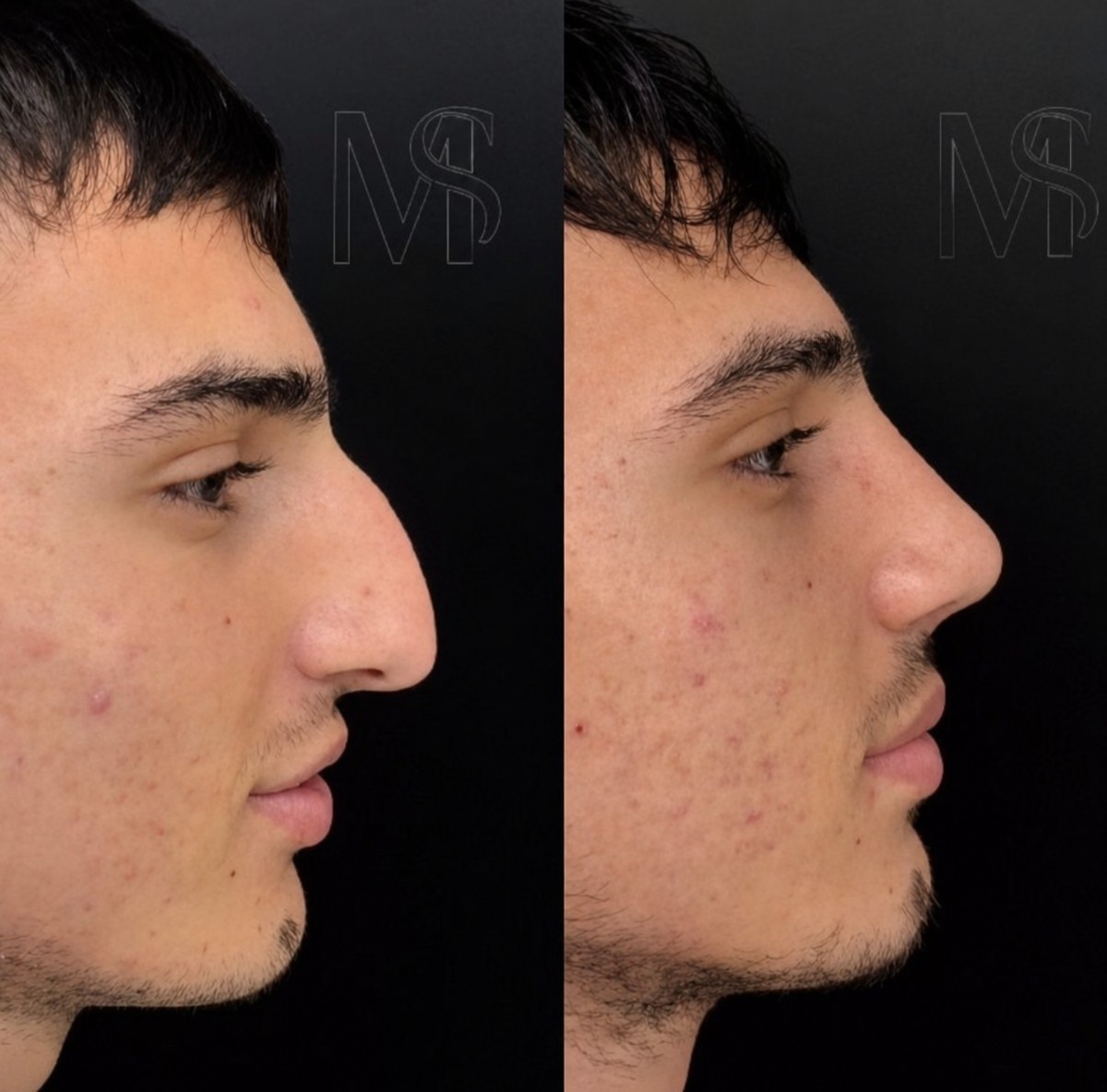 Resultados de rinoplastia antes y después en MERT SECER AESTHETIC AND PLASTIC SURGEON, remodelación nasal
