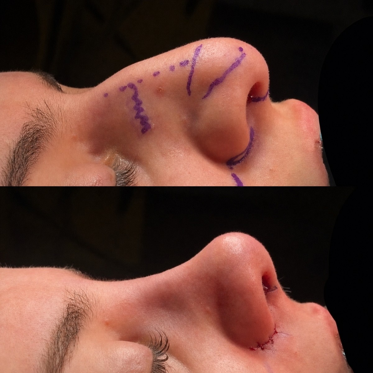 نتائج تجميل الأنف قبل وبعد في MERT SECER AESTHETIC AND PLASTIC SURGEON، إعادة تشكيل الأنف