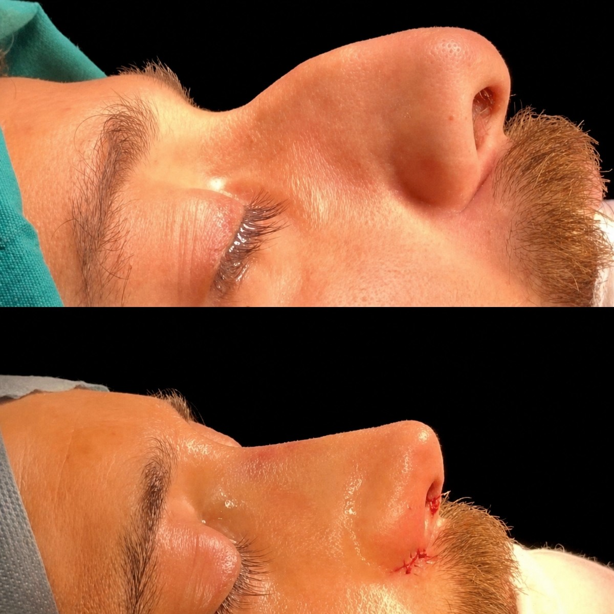 نتائج تجميل الأنف قبل وبعد في MERT SECER AESTHETIC AND PLASTIC SURGEON، إعادة تشكيل الأنف