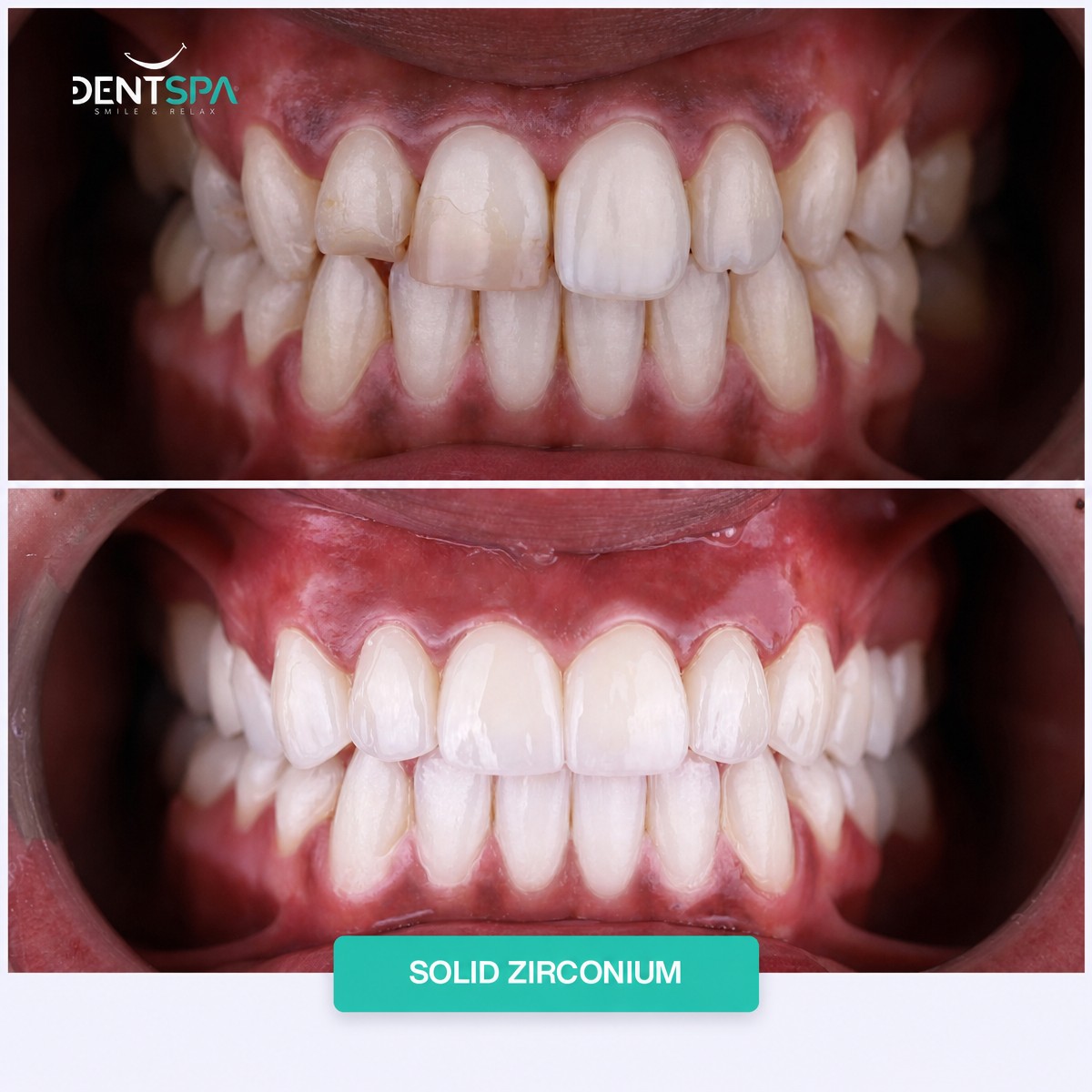 Результаты до и после установки коронок из циркония в DentSpa, преображение улыбки