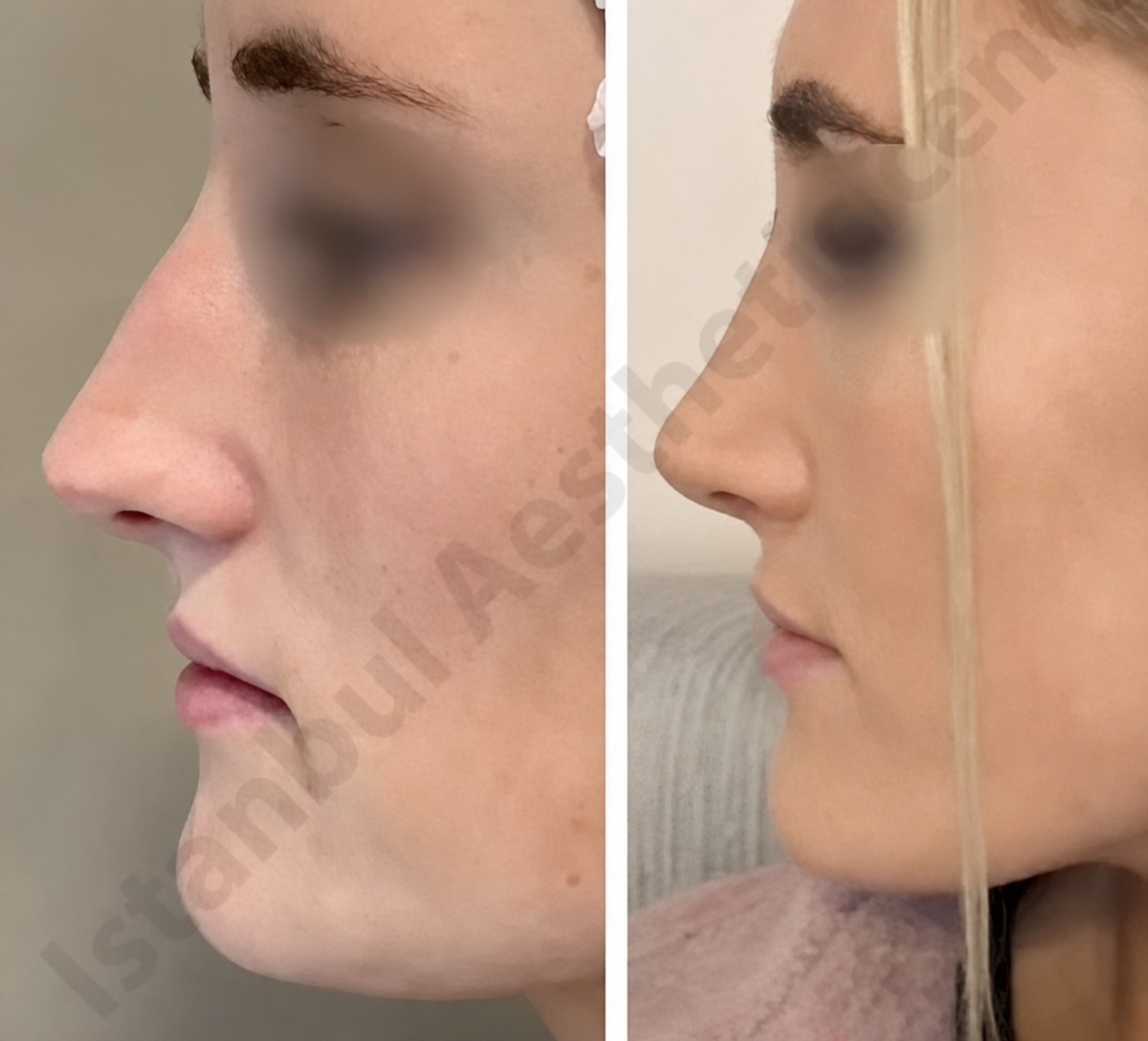 Efekty zamkniętej plastyki nosa przed i po w Istanbul Aesthetic Plastic Surgery Center