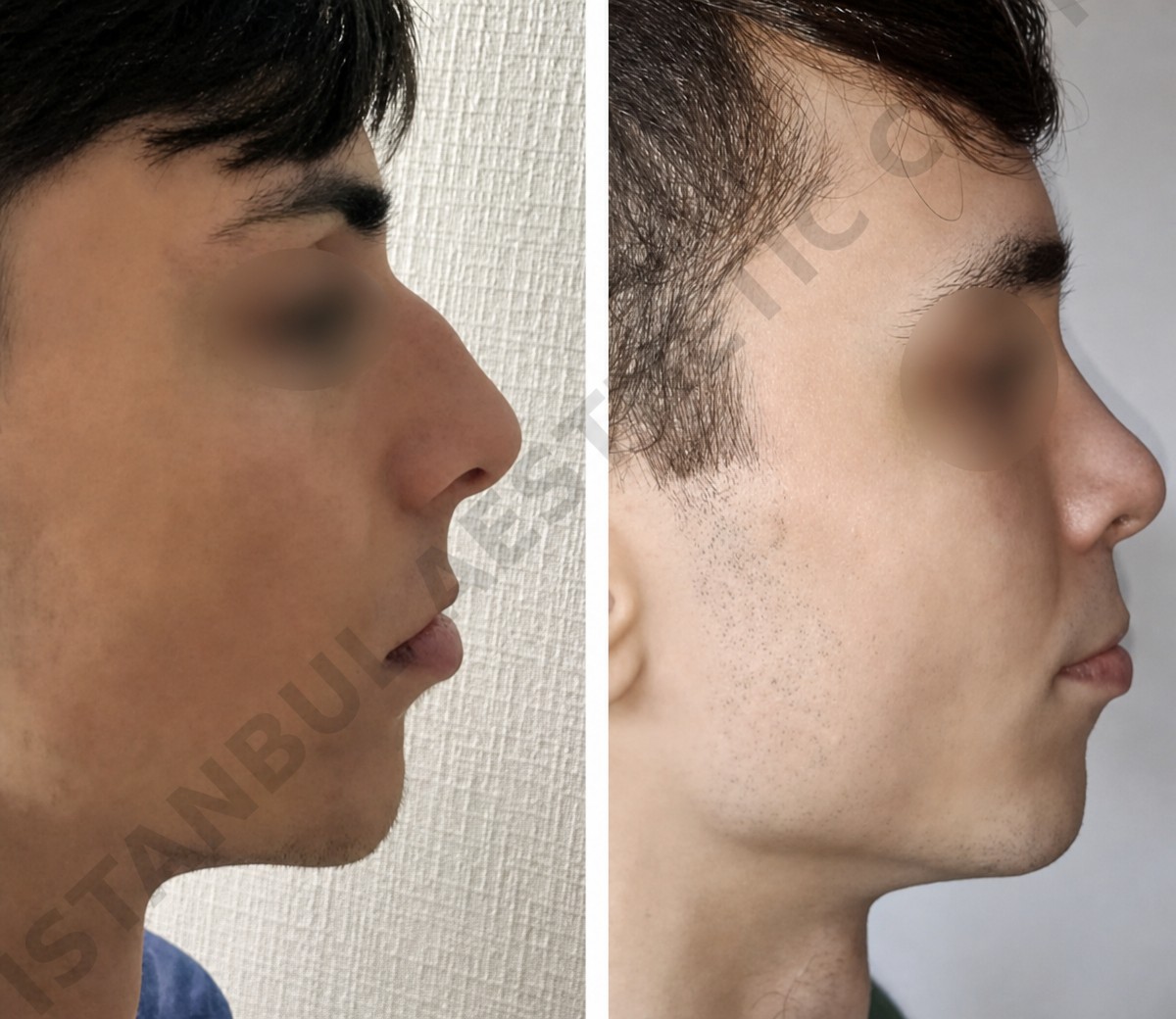Before and after rhinoplasty results at Istanbul Aesthetic Plastic Surgery Center, nose reshaping