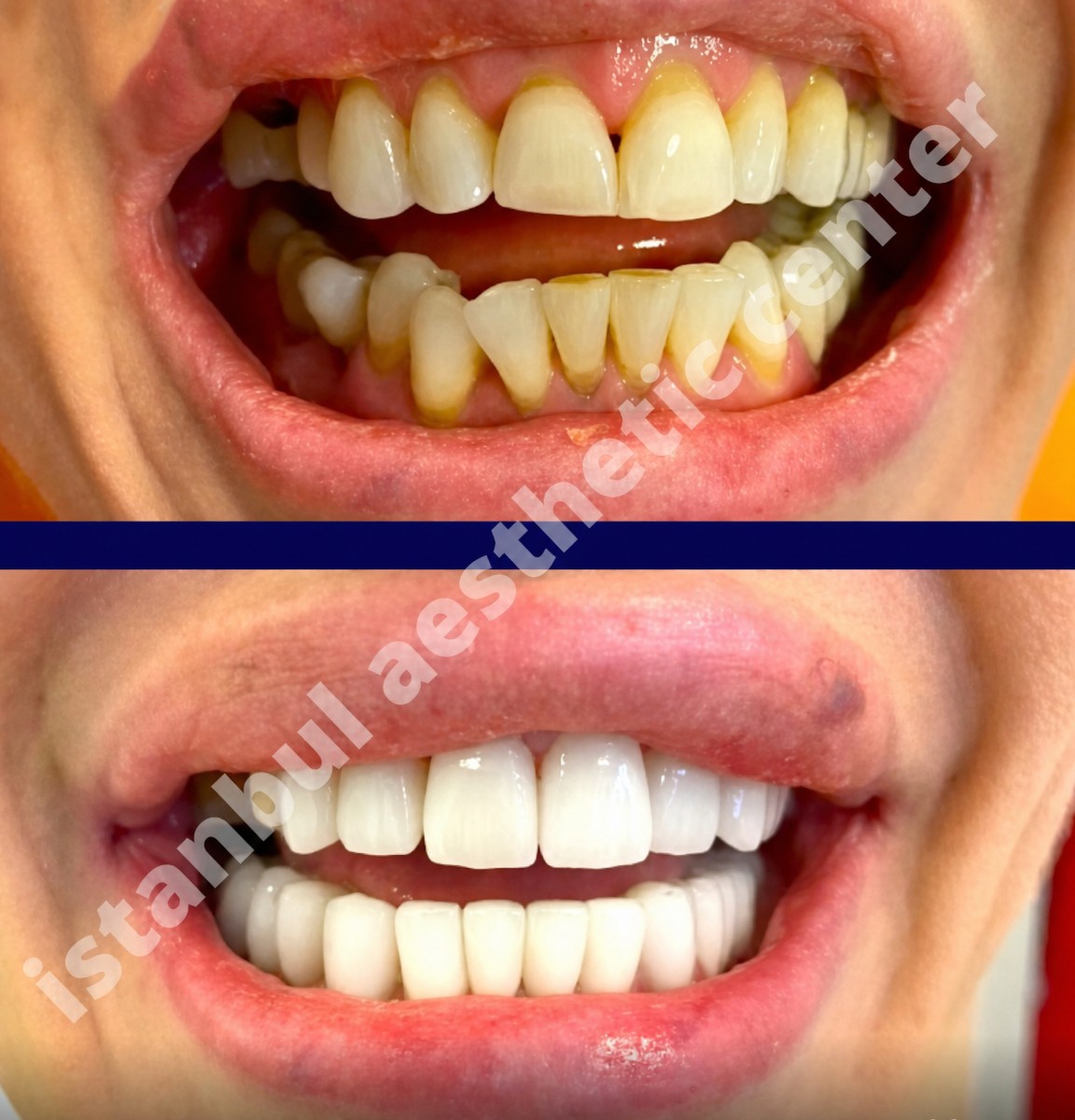 Resultados antes y después de carillas de porcelana en Istanbul Aesthetic Plastic Surgery Center