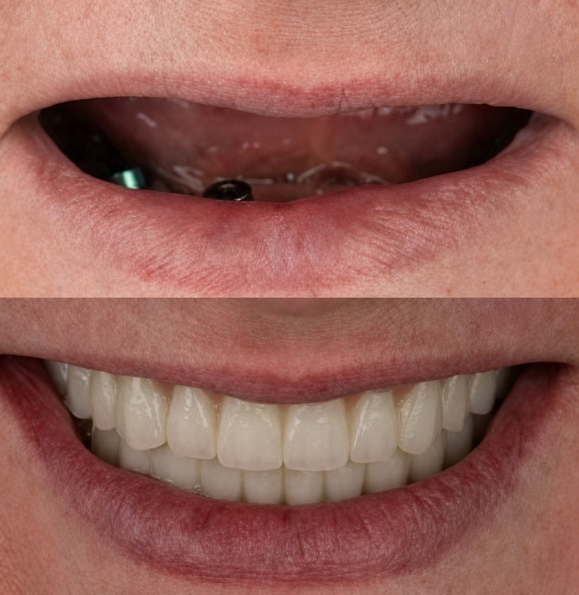 Resultado antes y después de implantes dentales All-on-6 en Adem and Havva Medical Center, sonrisa restaurada