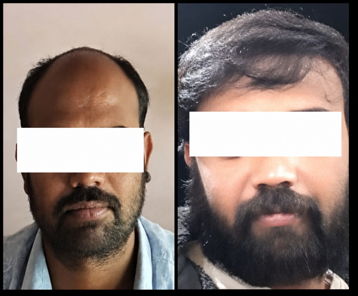 نتائج زراعة الشعر قبل وبعد في عيادات Vplant Speciality، استعادة خط الشعر للرجال