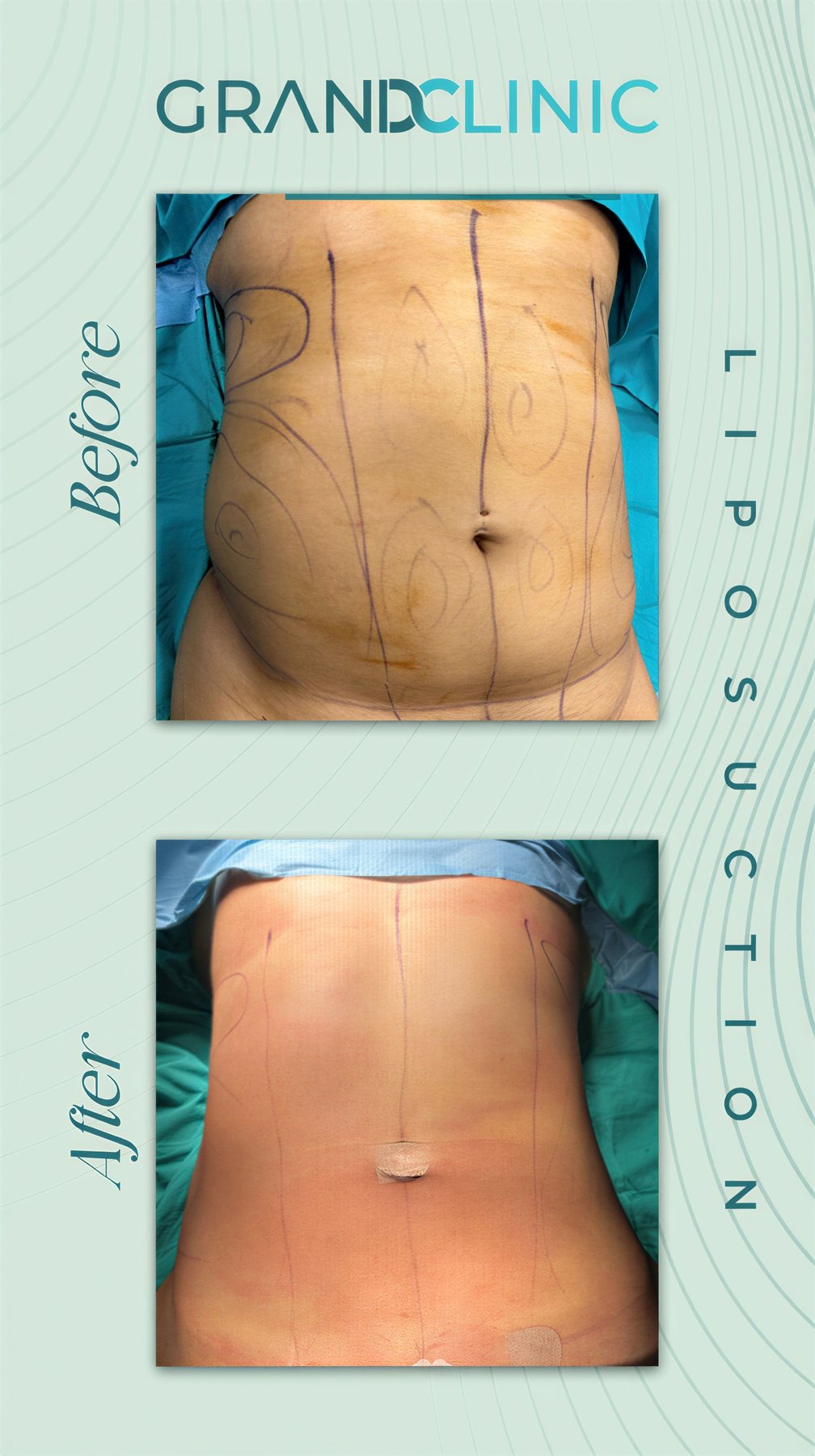Resultados de liposucción antes y después en Grand Clinic – mejora visible del abdomen