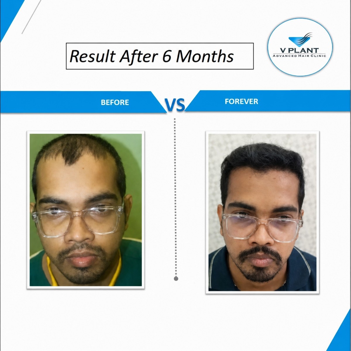 Resultados de trasplante capilar FUE antes y después en Vplant Speciality Clinics, 6 meses