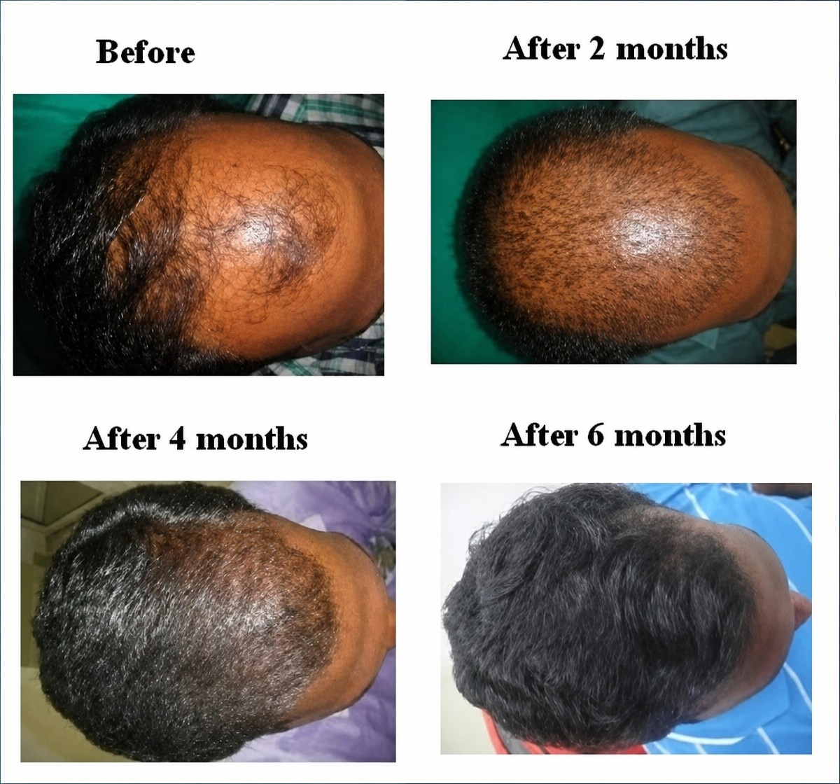Resultados de trasplante capilar FUE en Vplant Speciality Clinics, progreso en 6 meses