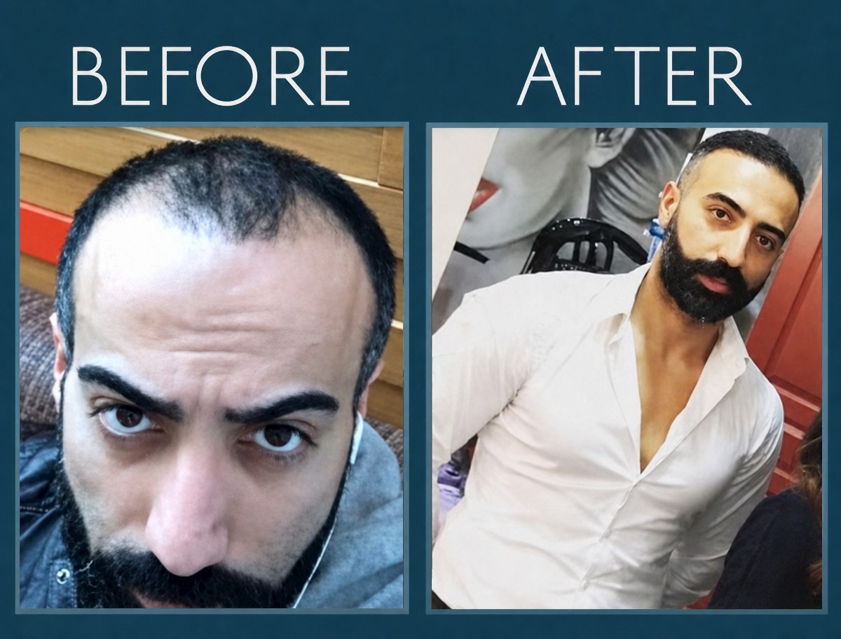 Resultados antes y después de trasplante capilar FUE en Hair Clinic, línea restaurada