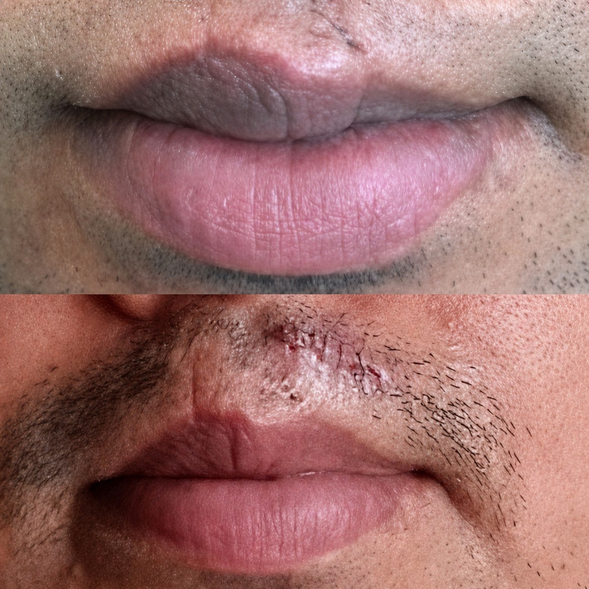 نتائج تصغير الشفاه قبل وبعد في Konarc Aesthetics، تقليل واضح لحجم الشفاه