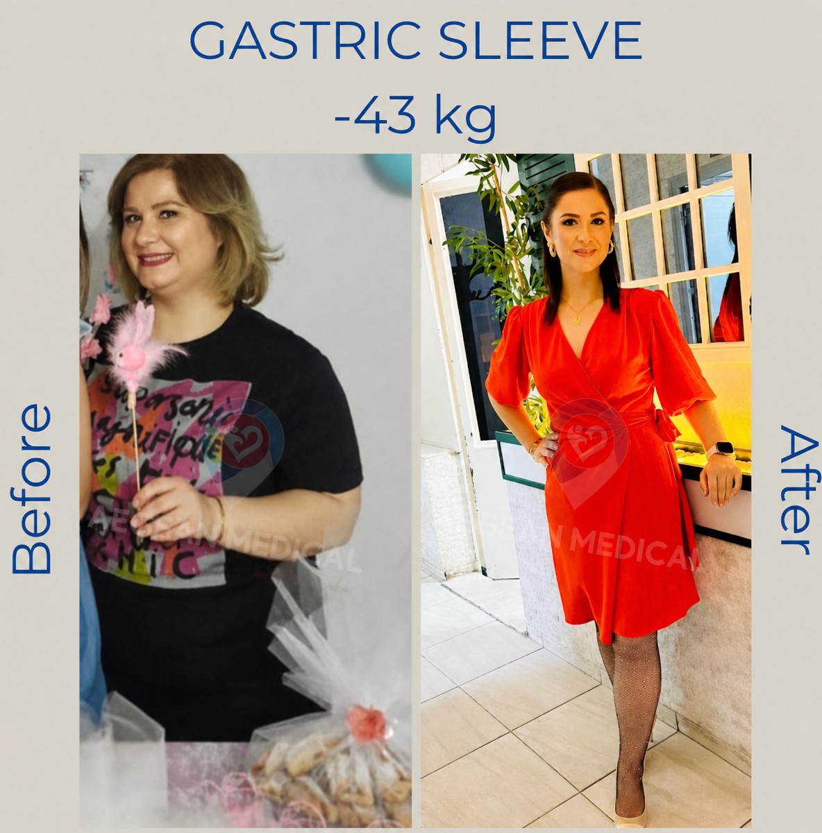 Resultados antes y después de manga gástrica en Aegean Medical Turkey, -43 kg de peso