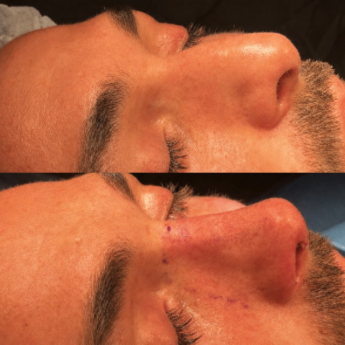 نتائج عملية تجميل الأنف قبل وبعد في Adem and Havva Medical Center، تحسين شكل الأنف