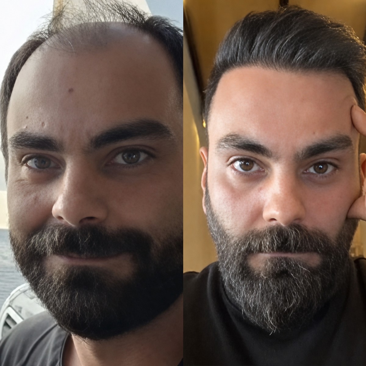 Before and after hair transplant results at Memorial Şişli Hospital, restored hairline in male