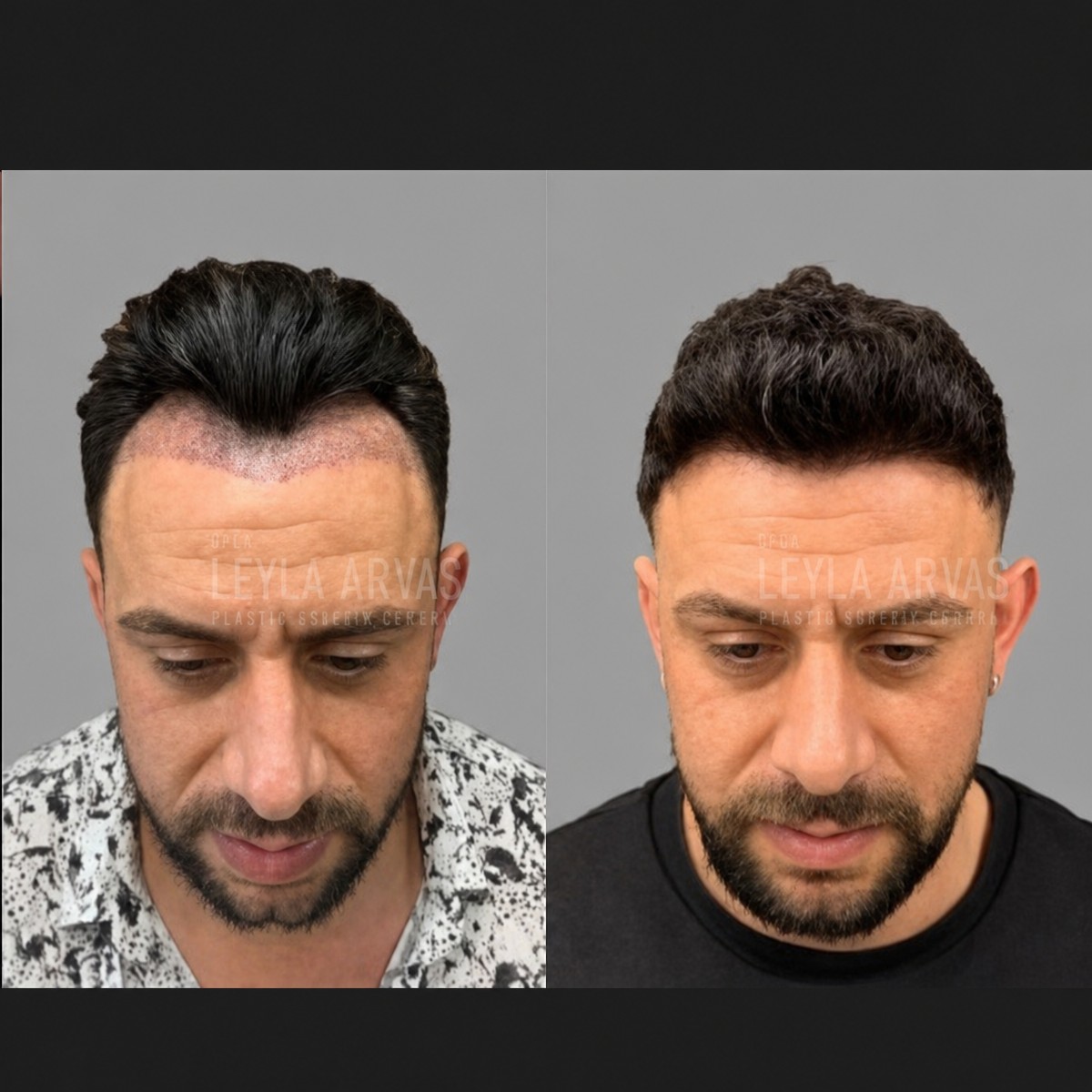 Before and after FUE hair transplant results at Quartz Hospital, improved hairline in male patient