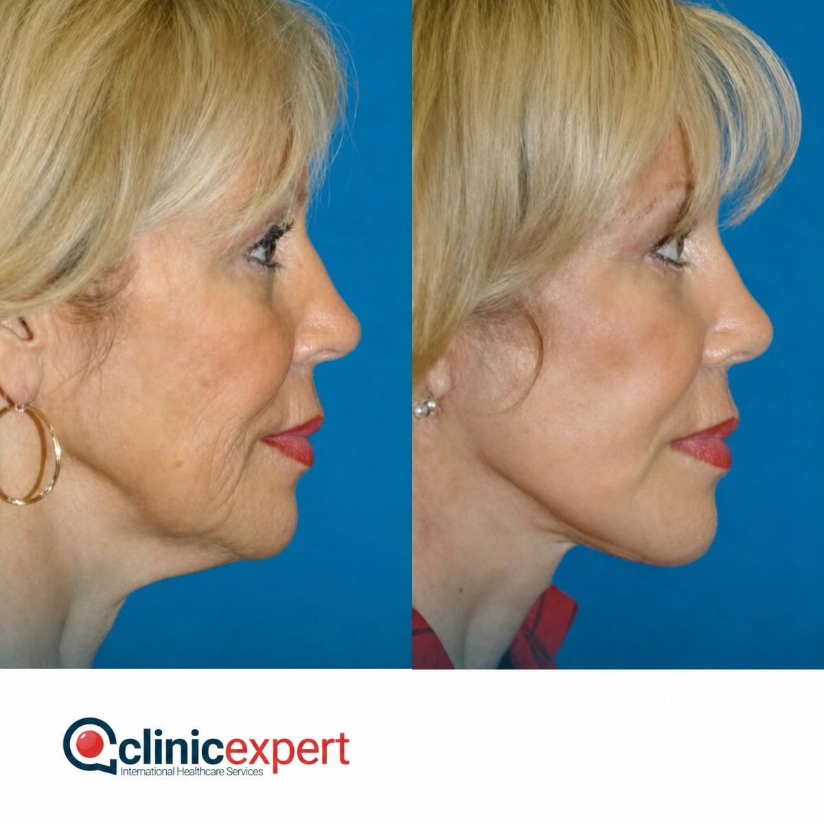Facelift before and after results at CE International Hospital, visible facial rejuvenation