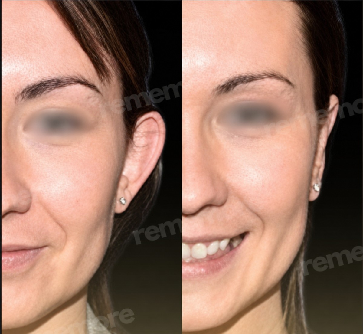 Before and after otoplasty results at Memorial Şişli Hospital, ear reshaping surgery outcome
