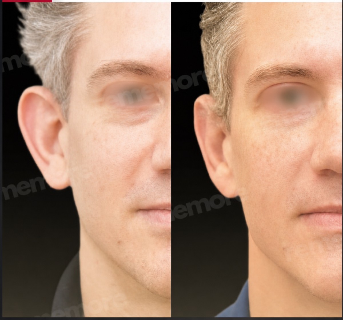 Before and after otoplasty results at Memorial Şişli Hospital, improved ear shape and symmetry